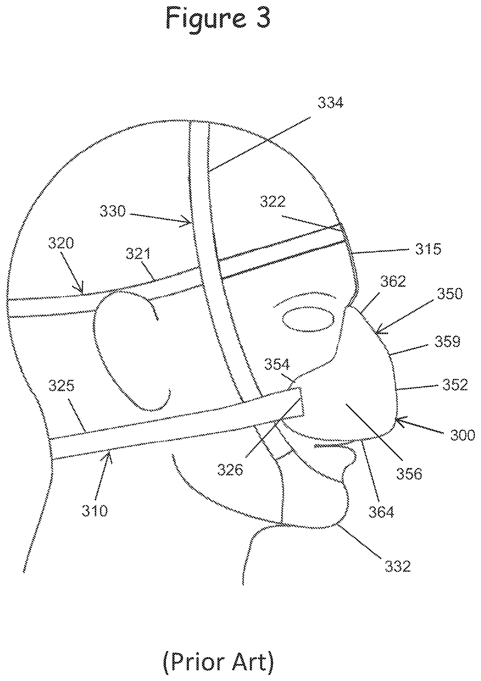 Patent US12599740 Figure 3 – Oral appliance for use with CPAP headgear