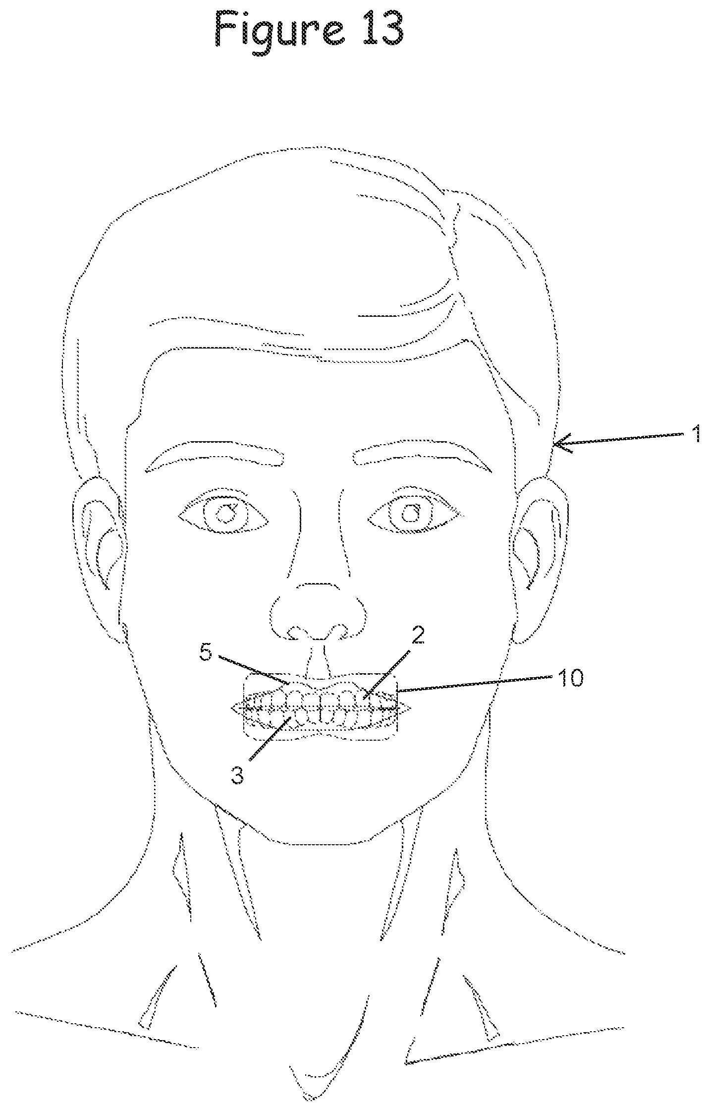 Patent US12599740 Figure 13 – Oral appliance for use with CPAP headgear