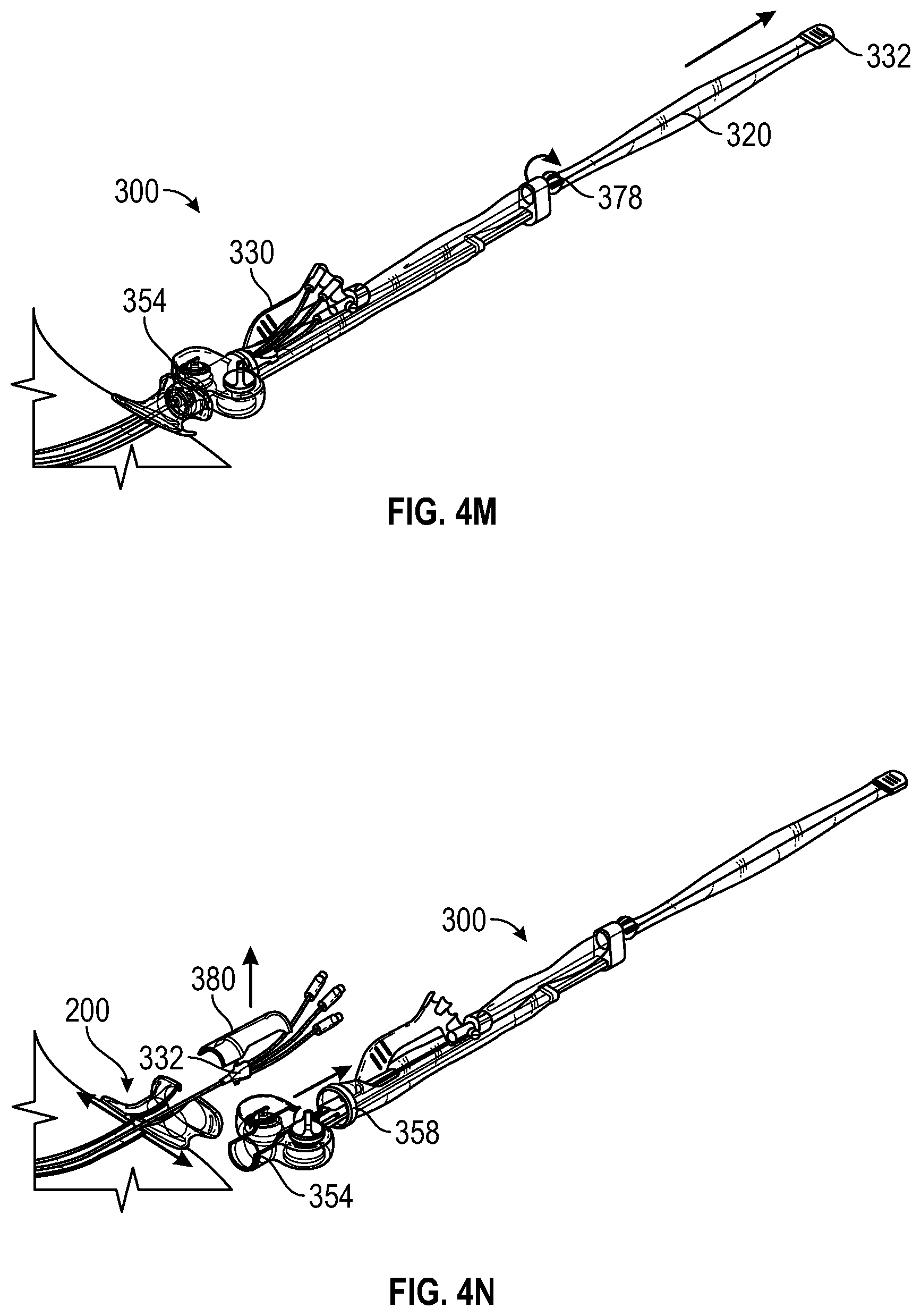Patent US12599752 Figure 11 – Splitable catheter docking station system and method