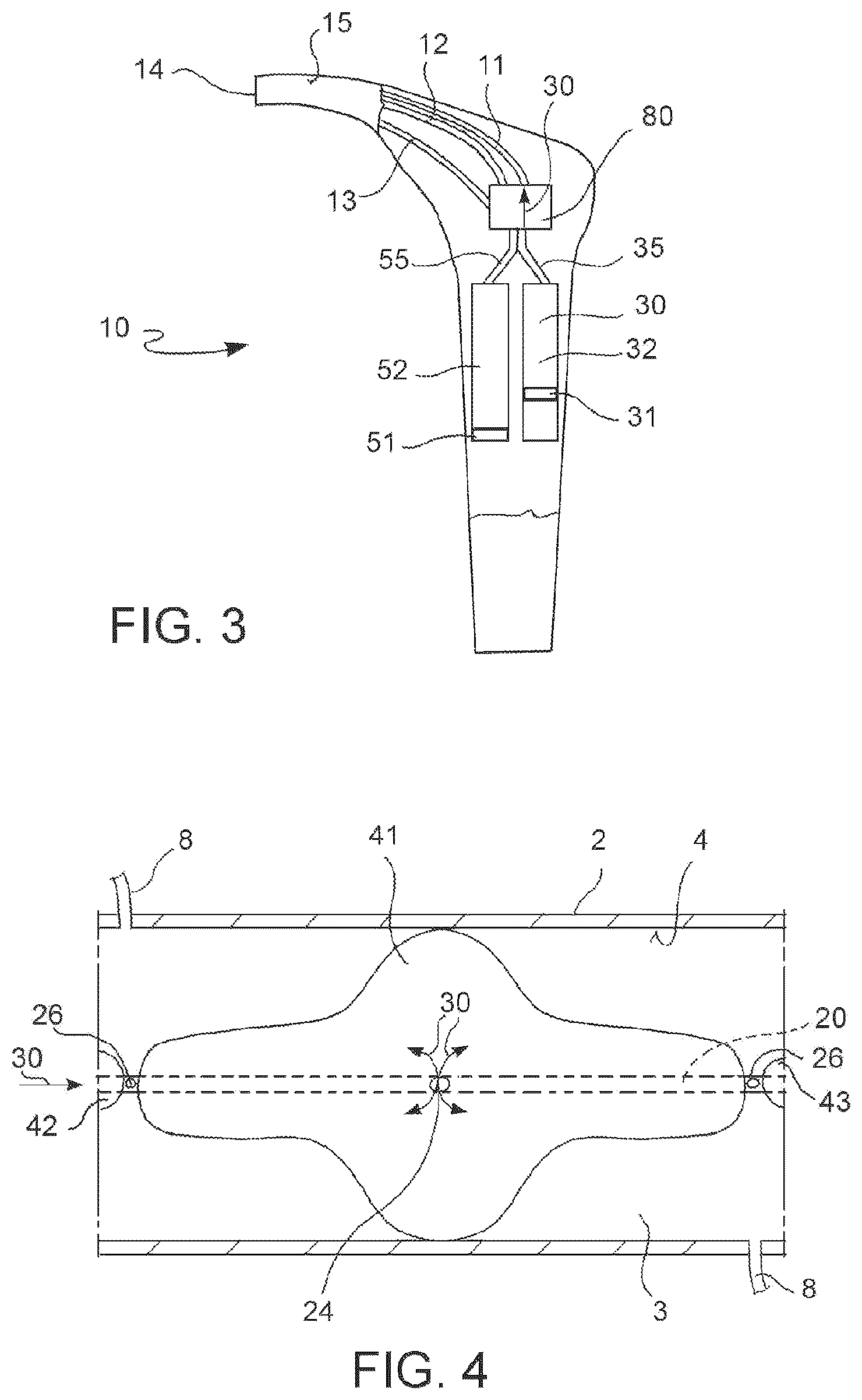 Patent US12599755 Figure 3 – Vascular catheter and method