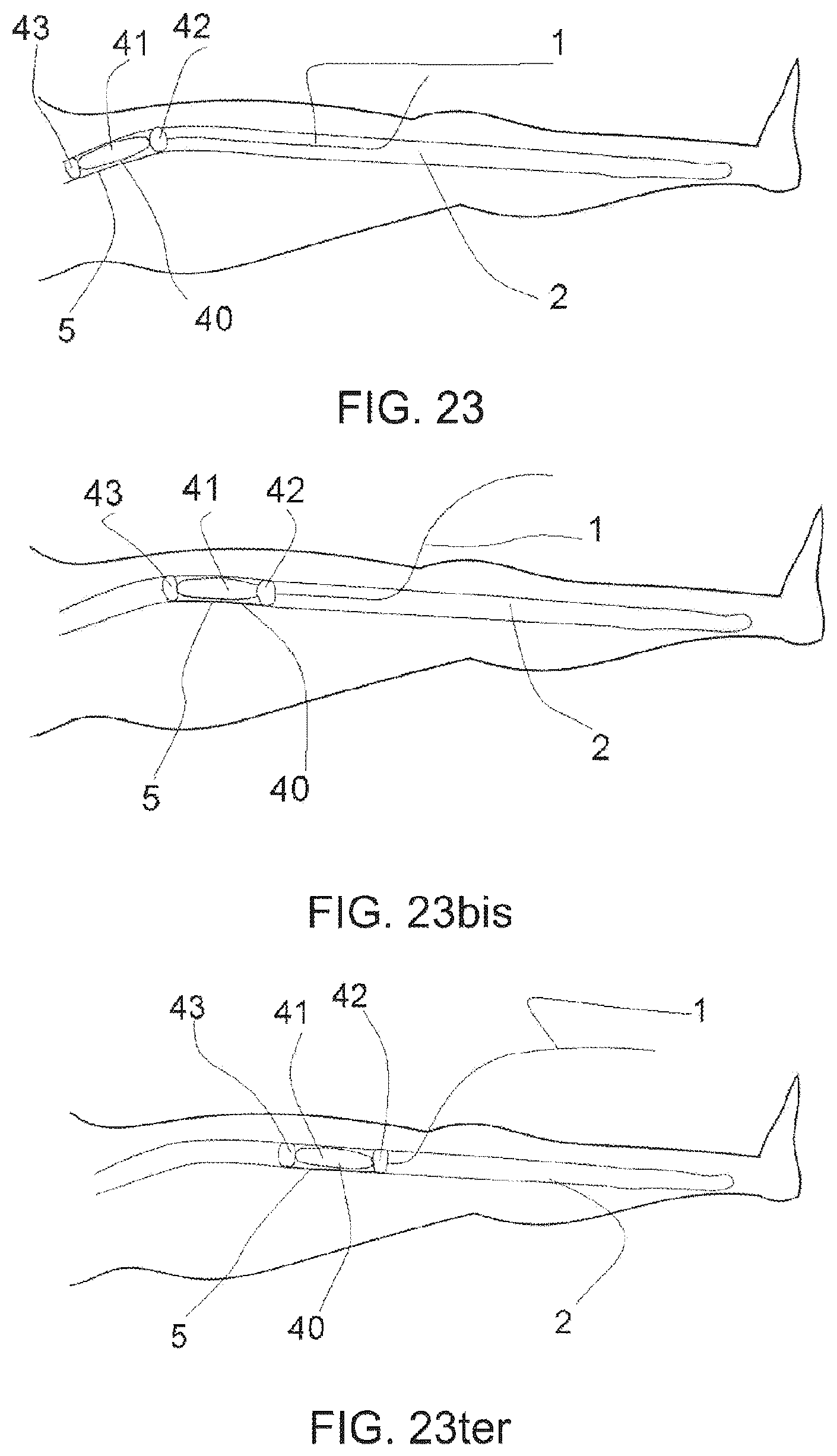 Patent US12599755 Figure 11 – Vascular catheter and method