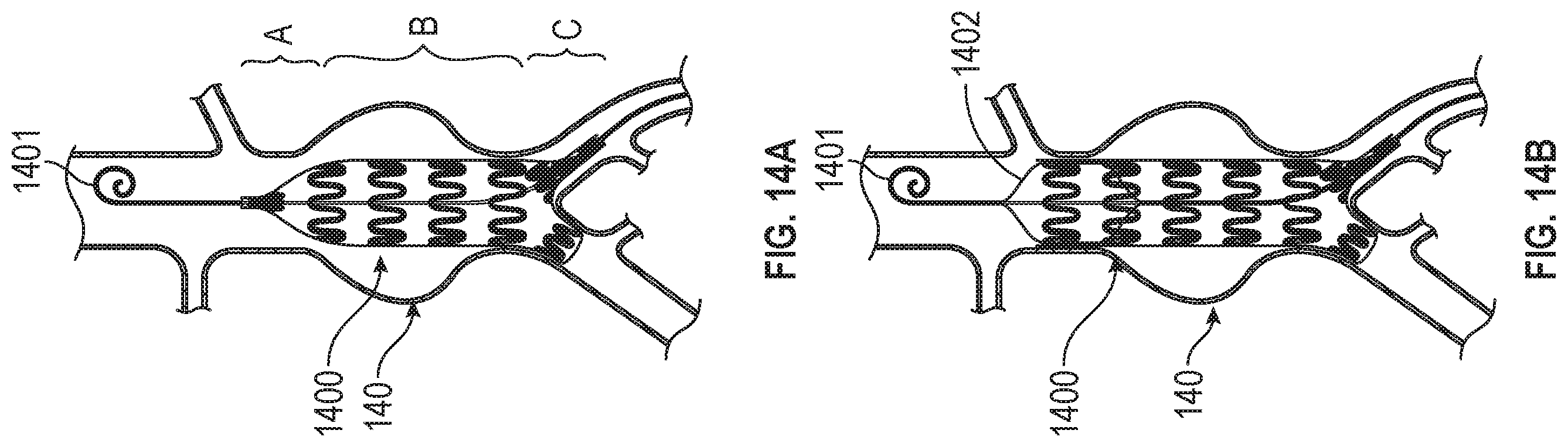 Patent US12599756 Figure 12 – Devices with dimensions that can be reduced and increased In Vivo