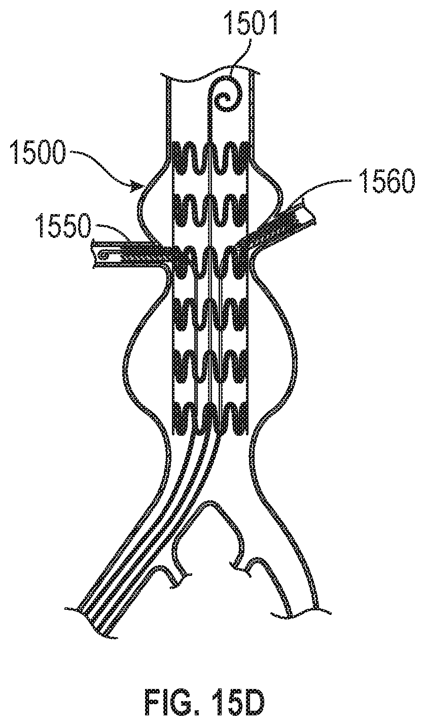 Patent US12599756 Figure 15 – Devices with dimensions that can be reduced and increased In Vivo