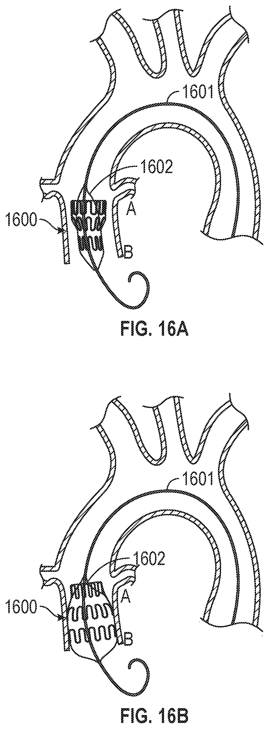 Patent US12599756 Figure 16 – Devices with dimensions that can be reduced and increased In Vivo