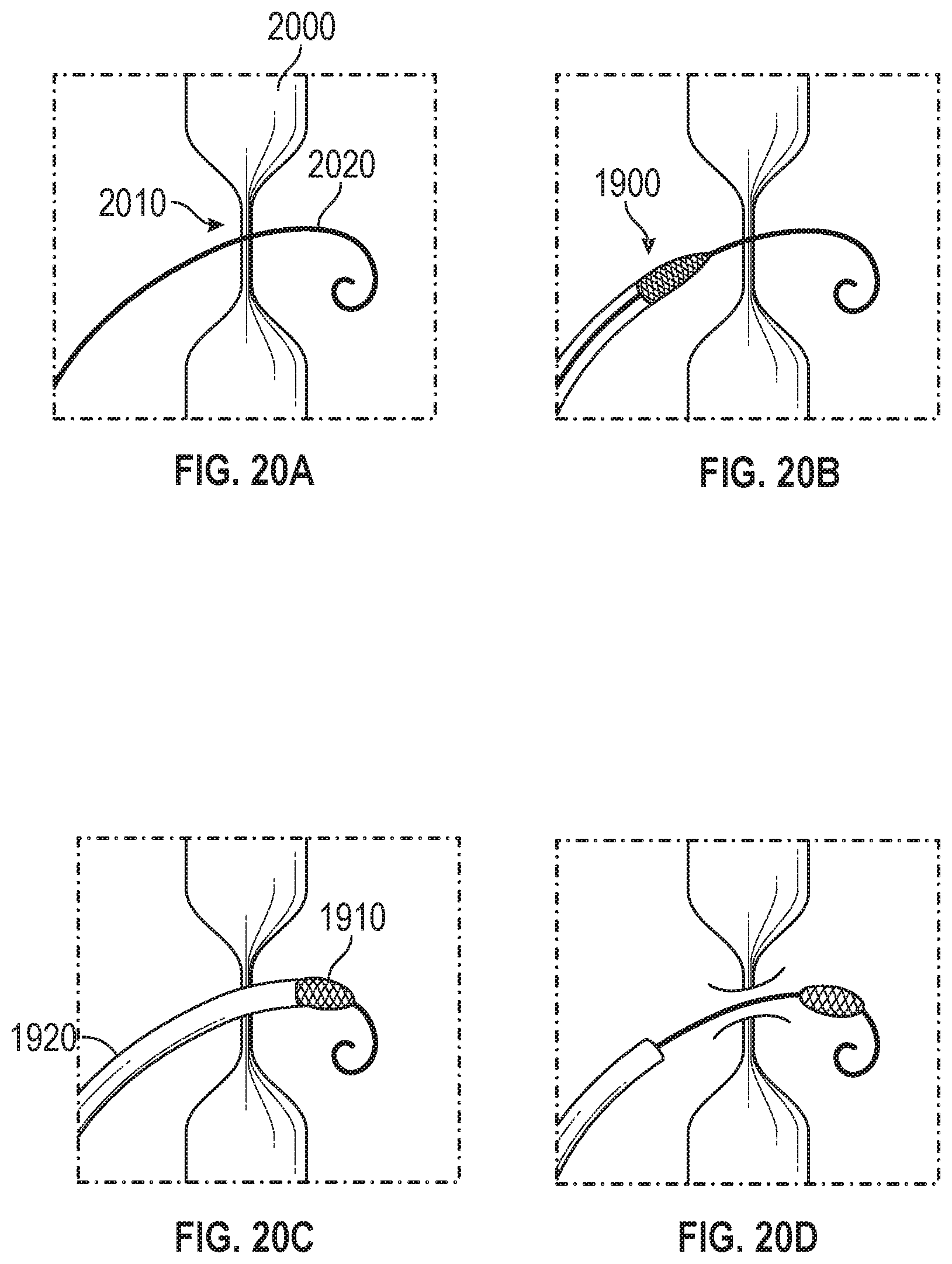 Patent US12599756 Figure 19 – Devices with dimensions that can be reduced and increased In Vivo