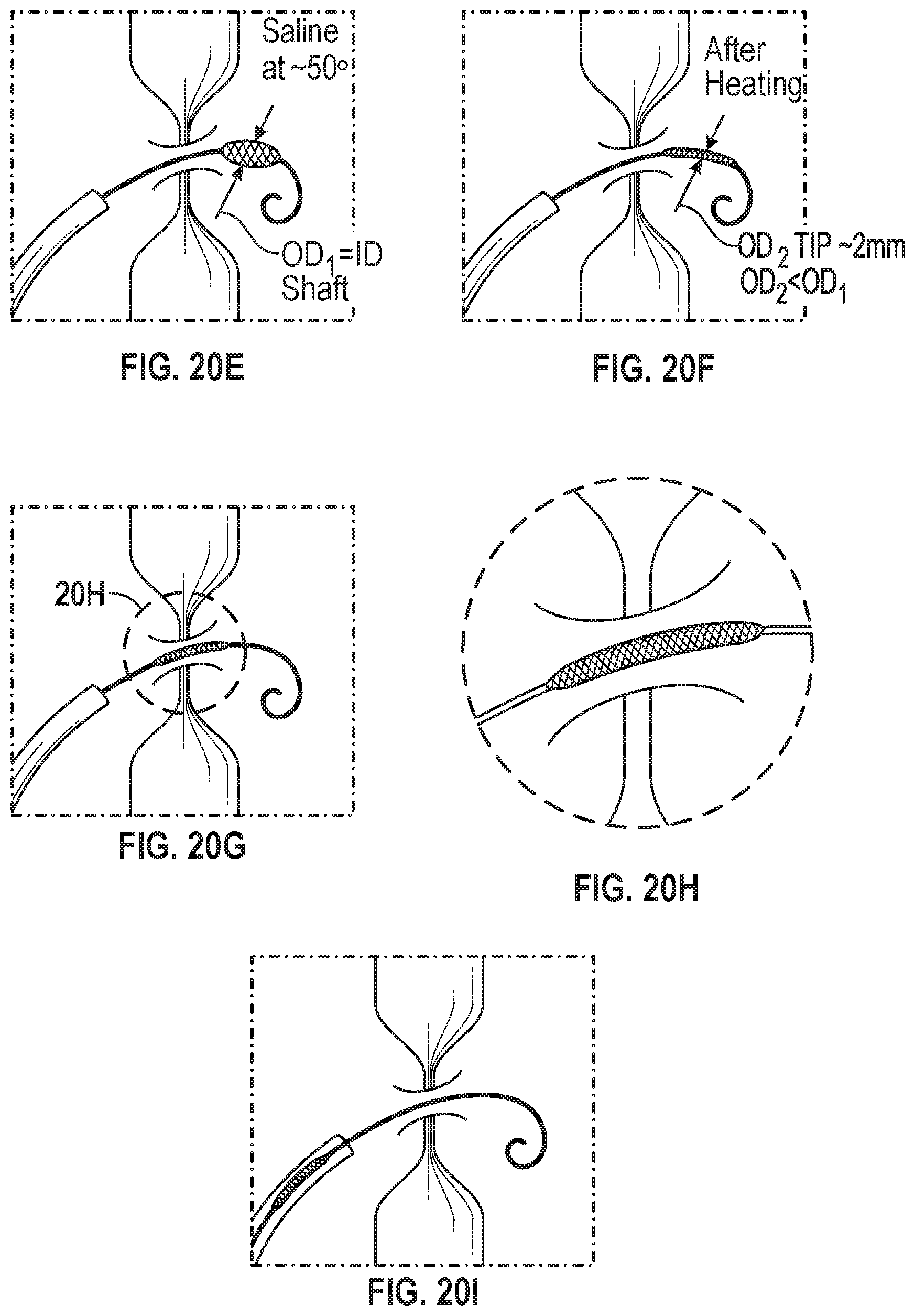 Patent US12599756 Figure 20 – Devices with dimensions that can be reduced and increased In Vivo