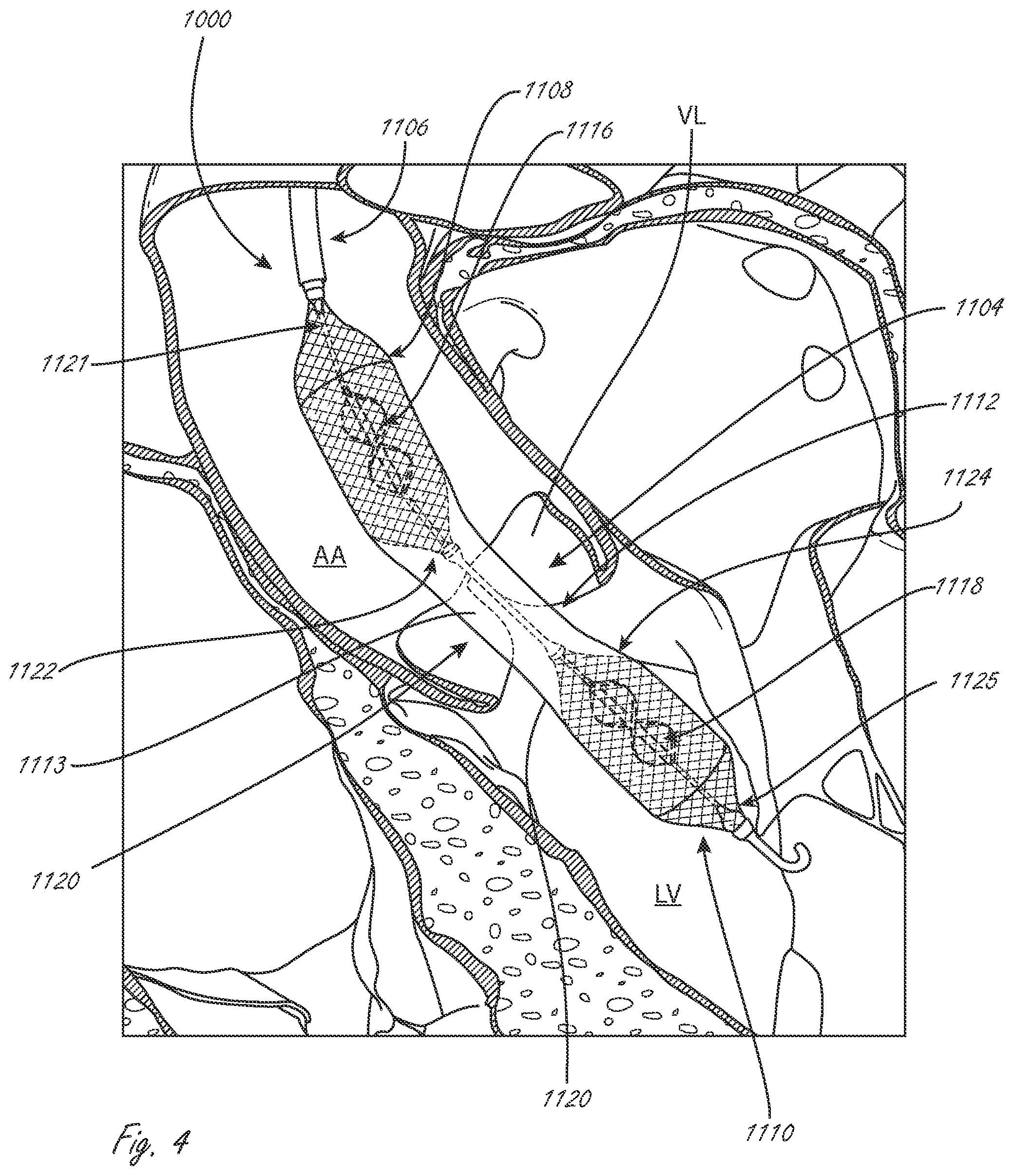 Patent US12599758 Figure 4 – Intravascular blood pumps, motors, and fluid control