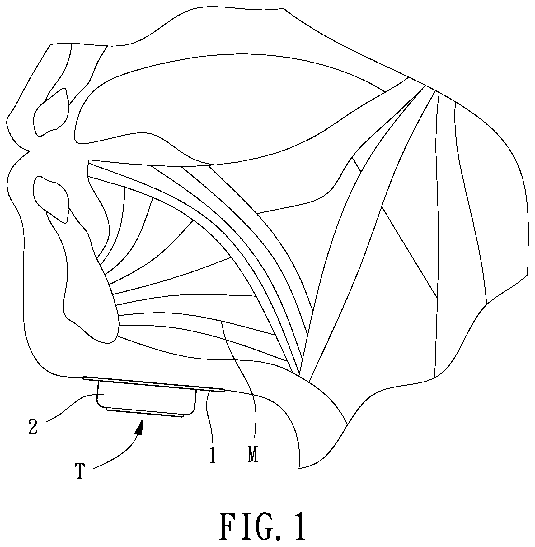 Patent US12599759 Figure 1 – Non-implantable training method for training genioglossus muscle strength