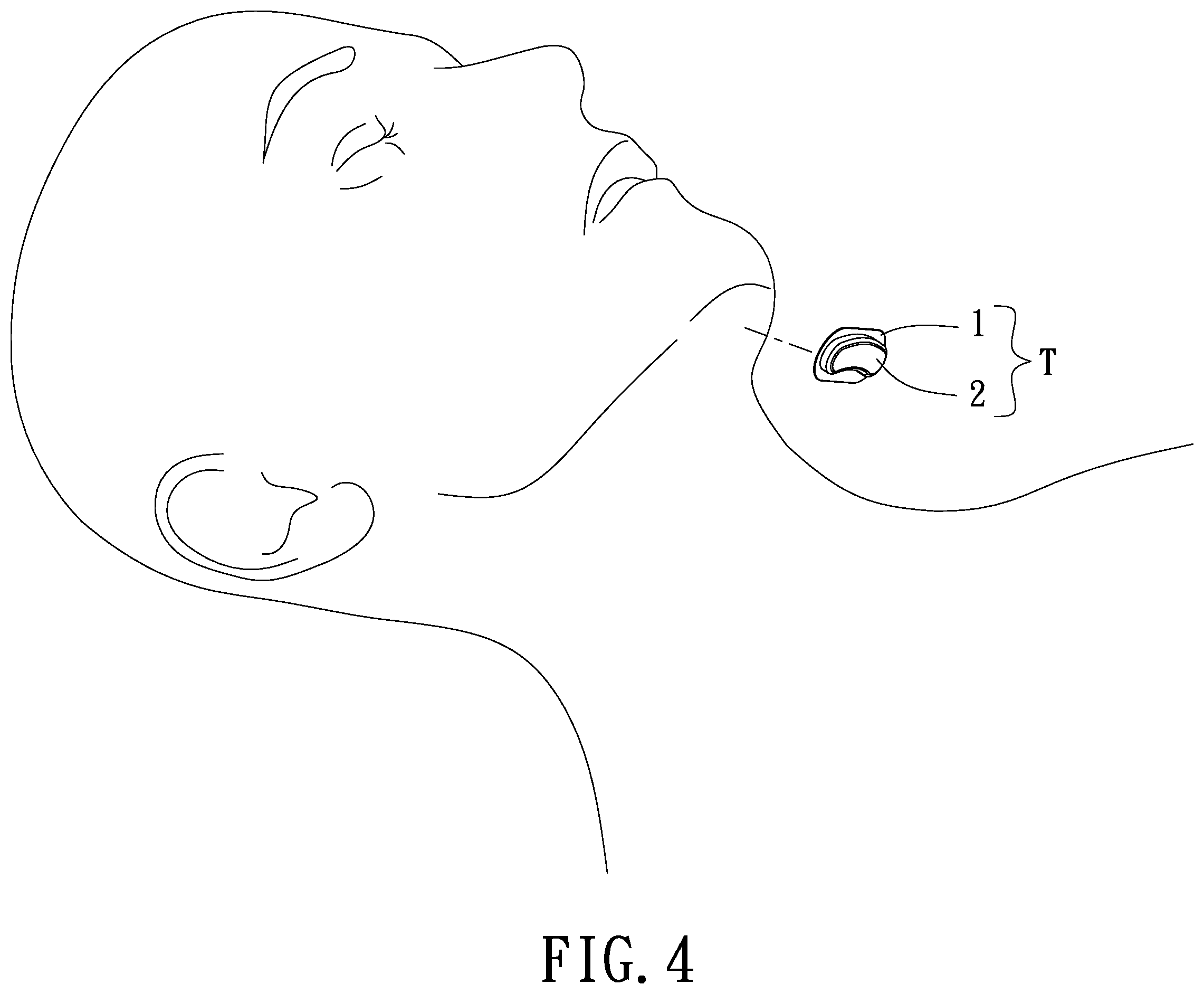 Patent US12599759 Figure 4 – Non-implantable training method for training genioglossus muscle strength