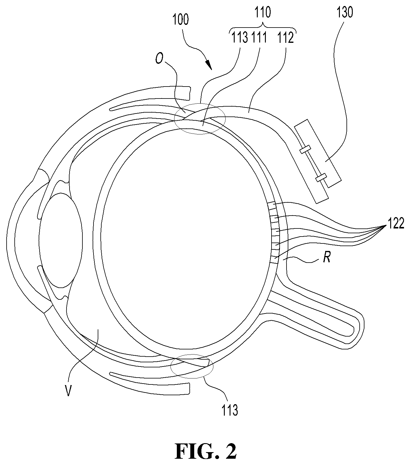 Patent US12599769 Figure 2 – Balloon-type retinal stimulation device and method for manufacturing same