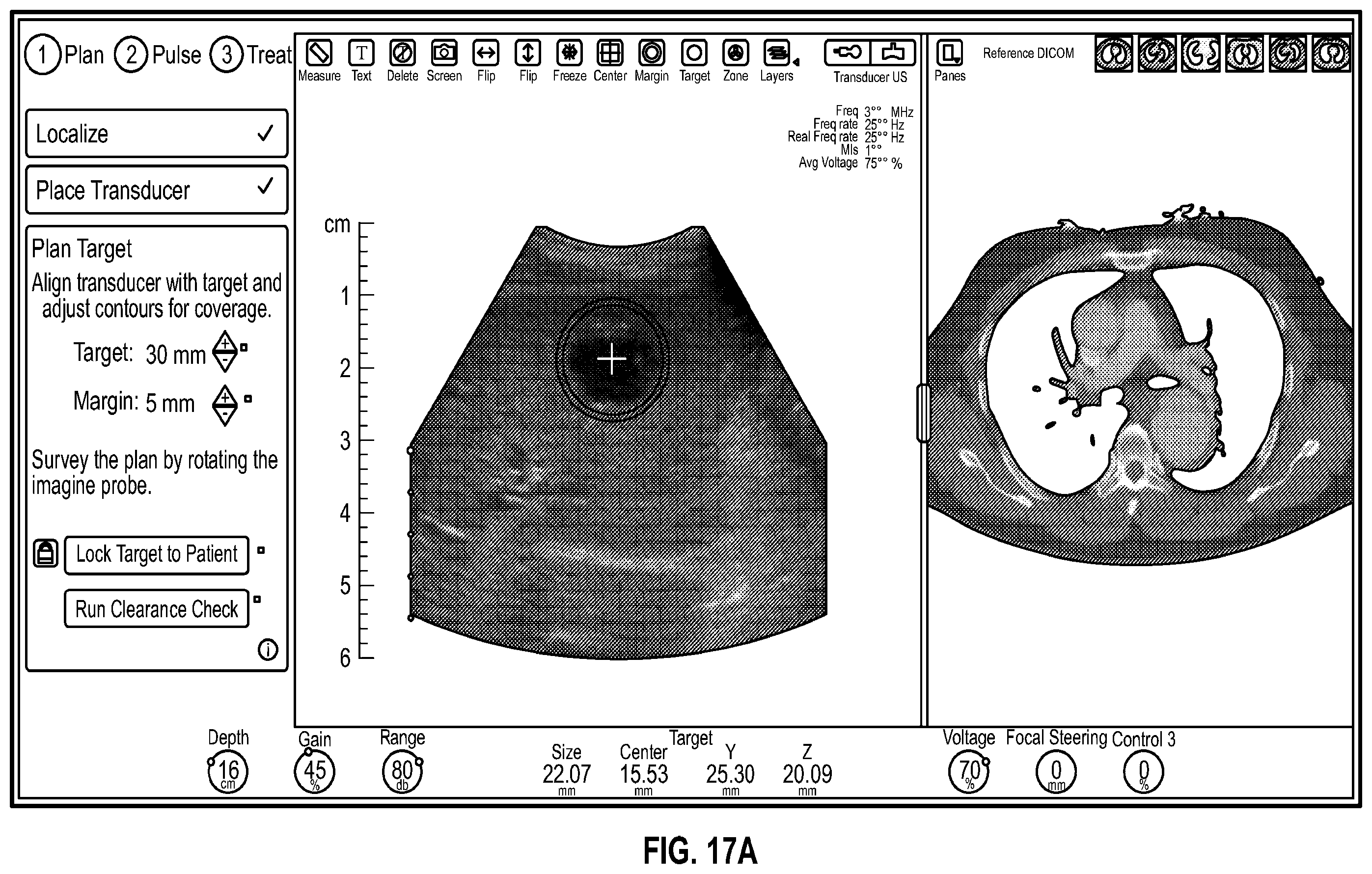 Patent US12599784 Figure 17 – Histotripsy systems and methods