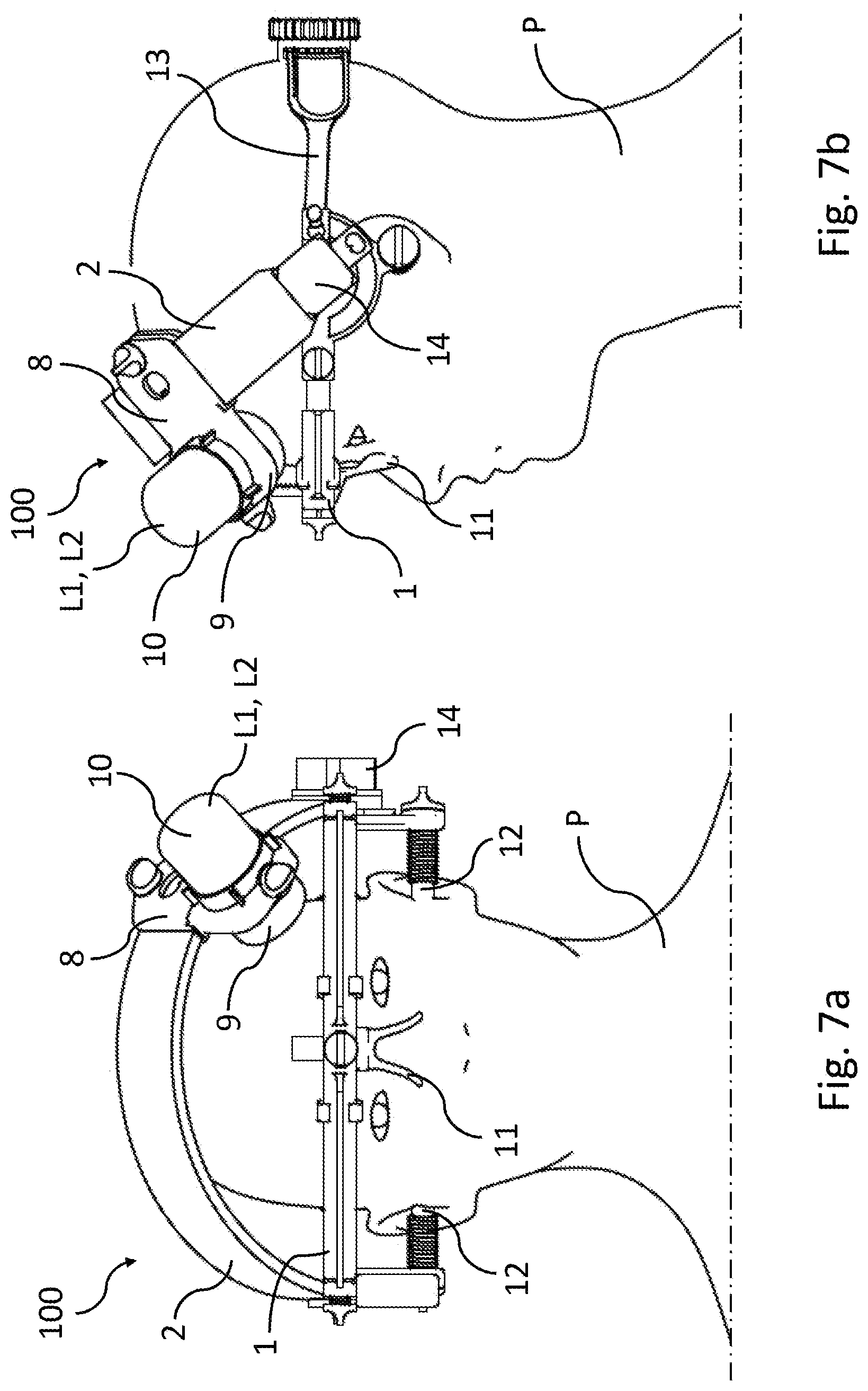 Patent US12599785 Figure 5 – Stereotactic device wearable by a patient for low-intensity focused-ultrasound neuromodulation