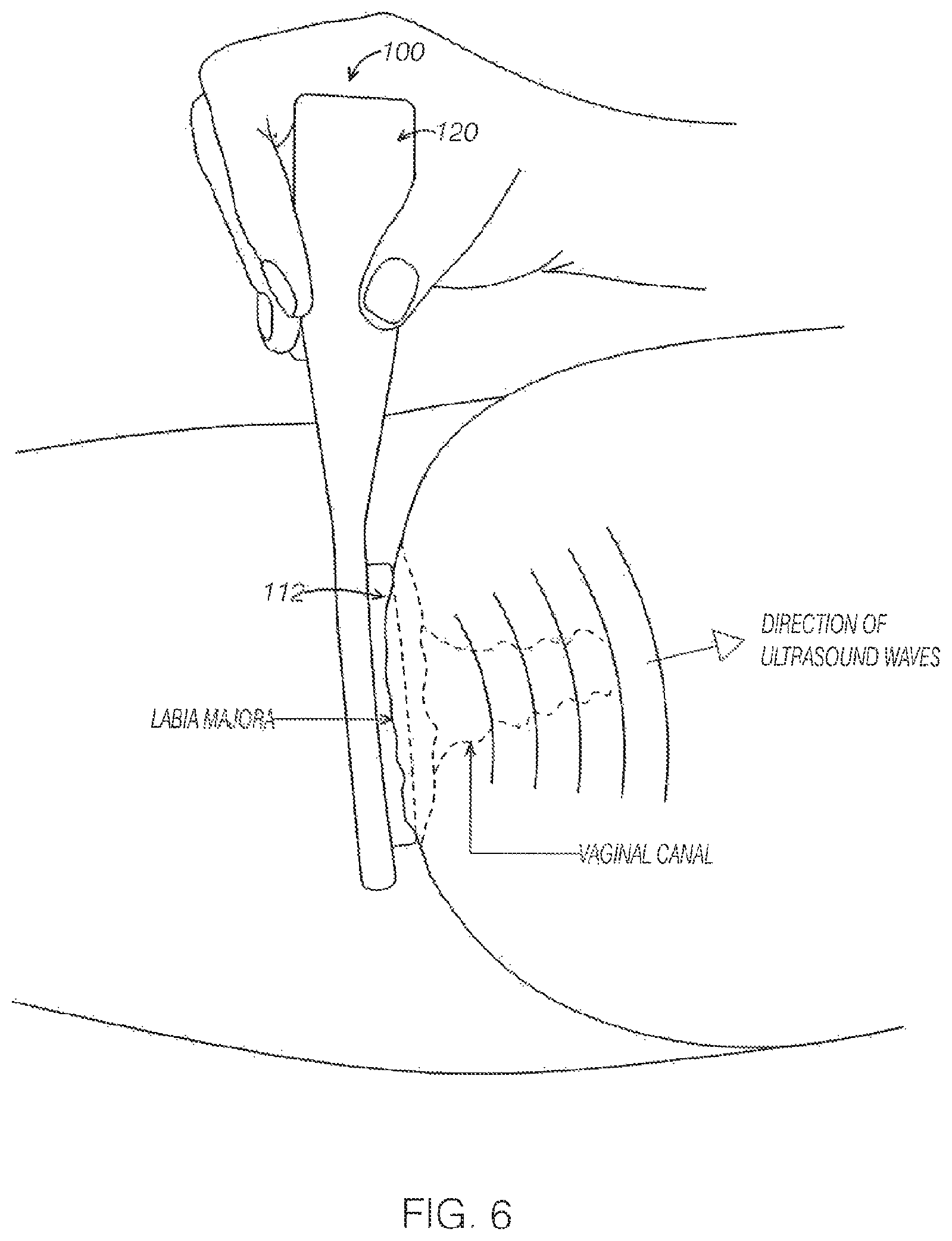 Patent US12599786 Figure 6 – Ultrasound device with attachable components