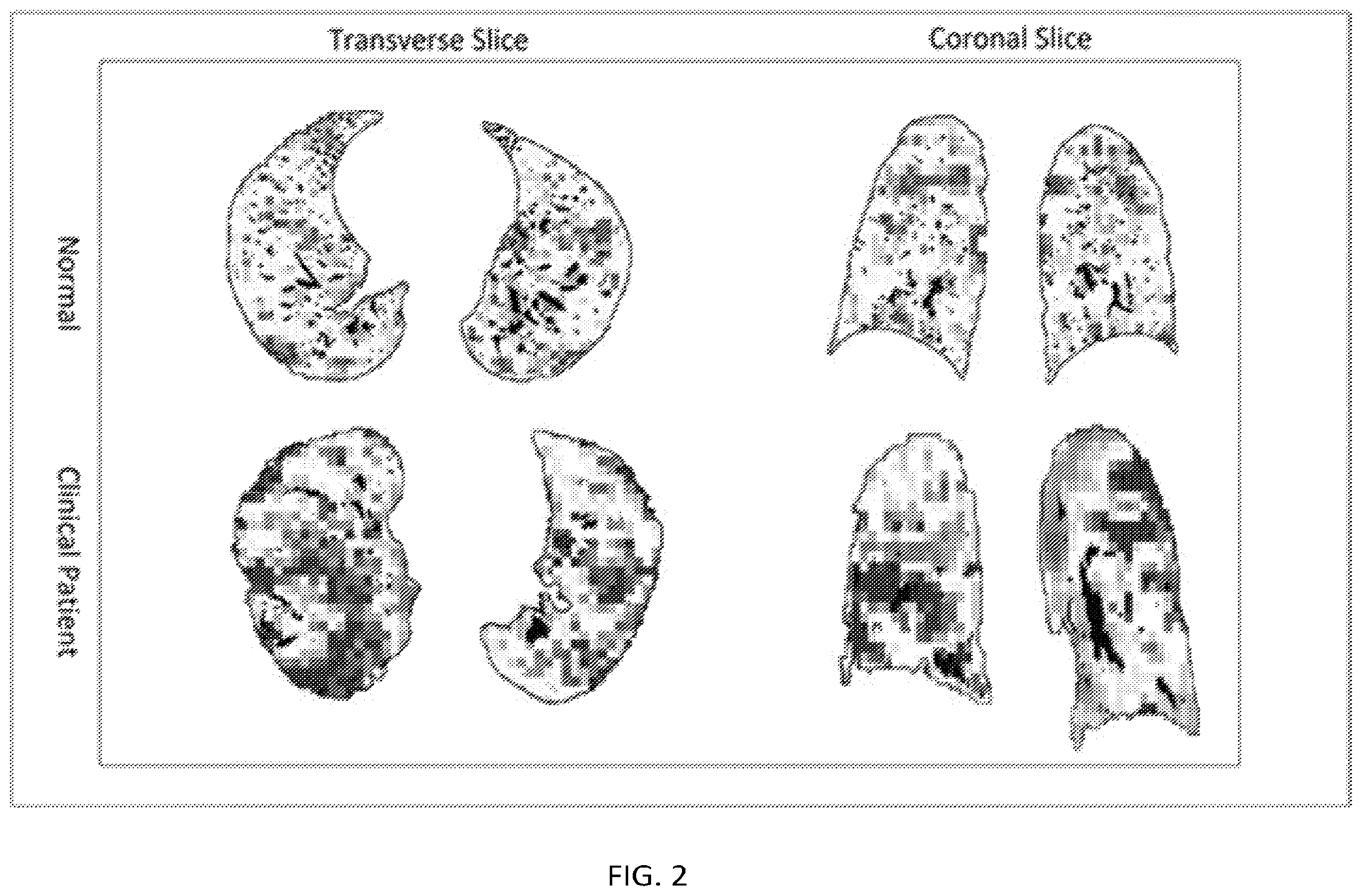Patent US12602774 Figure 2 – Regional pulmonary V/Q via image registration and multi-energy CT