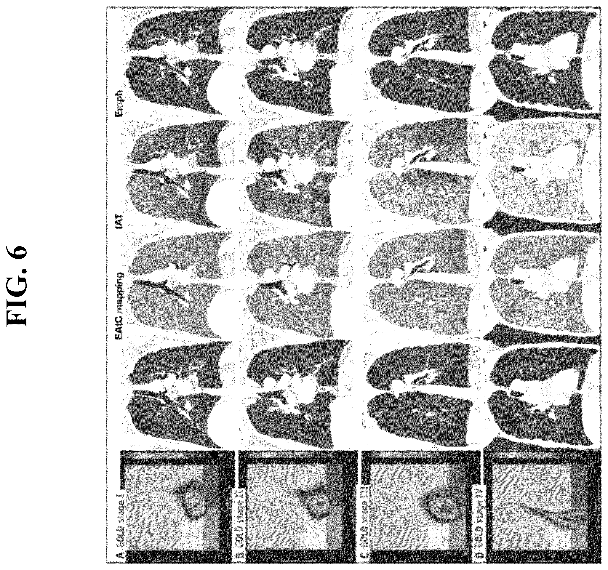 Patent US12602777 Figure 6 – Apparatus and method for quantitative assessment of medical images for diagnosis of chronic obstructive pulmonary disease
