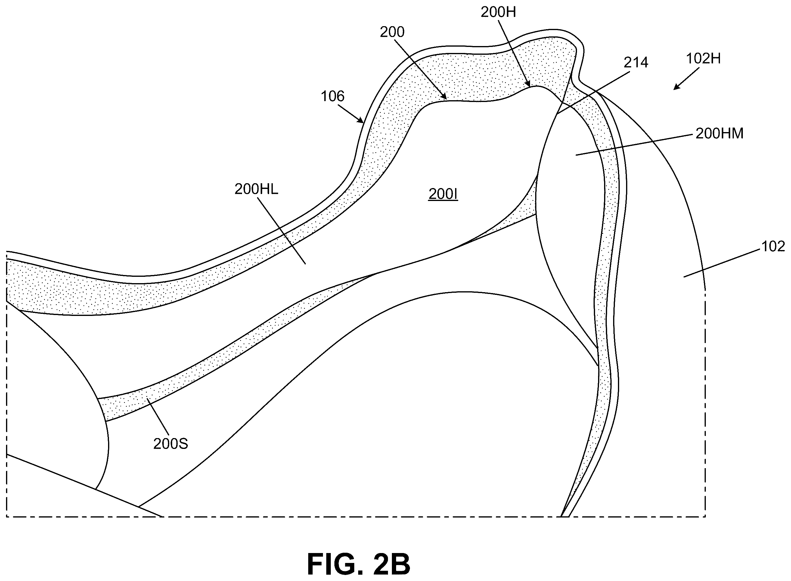 Patent US12611009 Figure 5 – Bladders, footwear uppers including bladders, and articles of footwear including bladders in the upper
