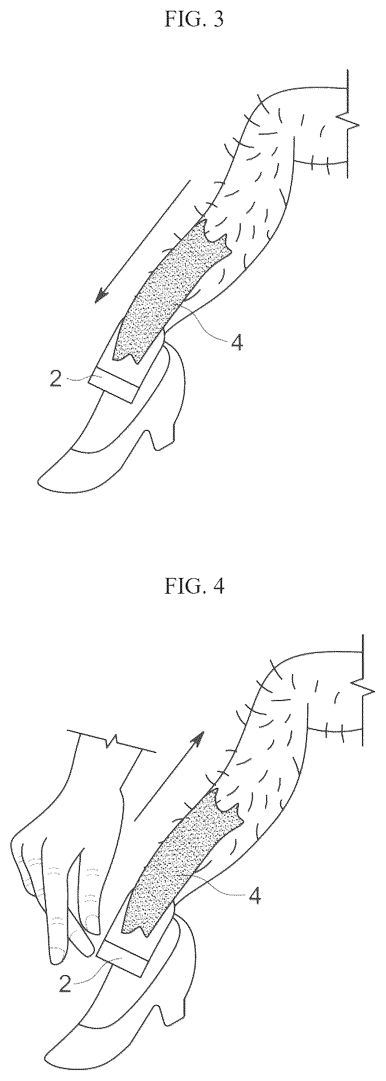 Patent US12611023 Figure 2 – Device with adhesive to aid in depilatory wax removal