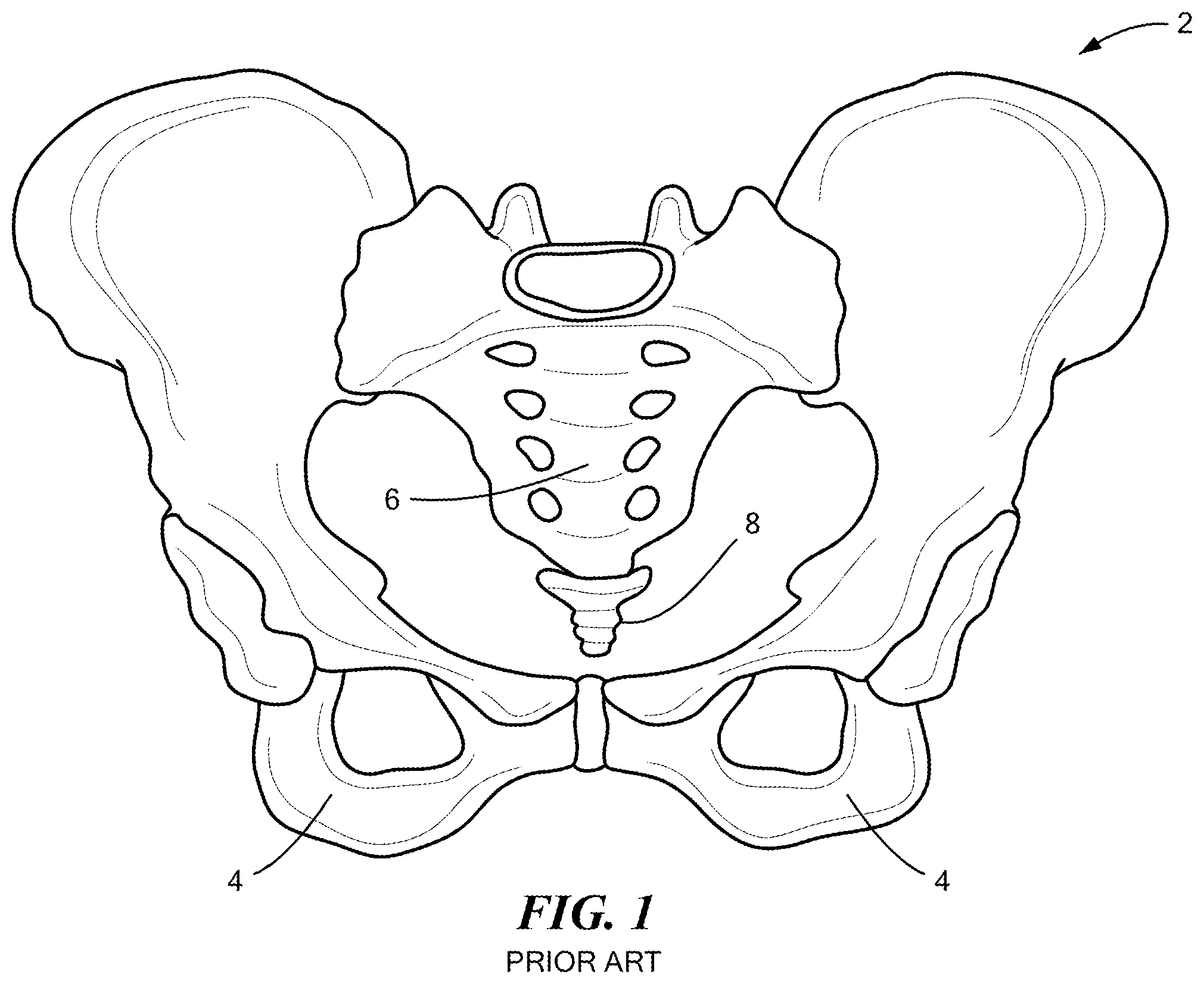 Patent US12611036 Figure 1 – Stackable lift for ischial tuberosity re-alignment of sacral/lumbar complex and method of use