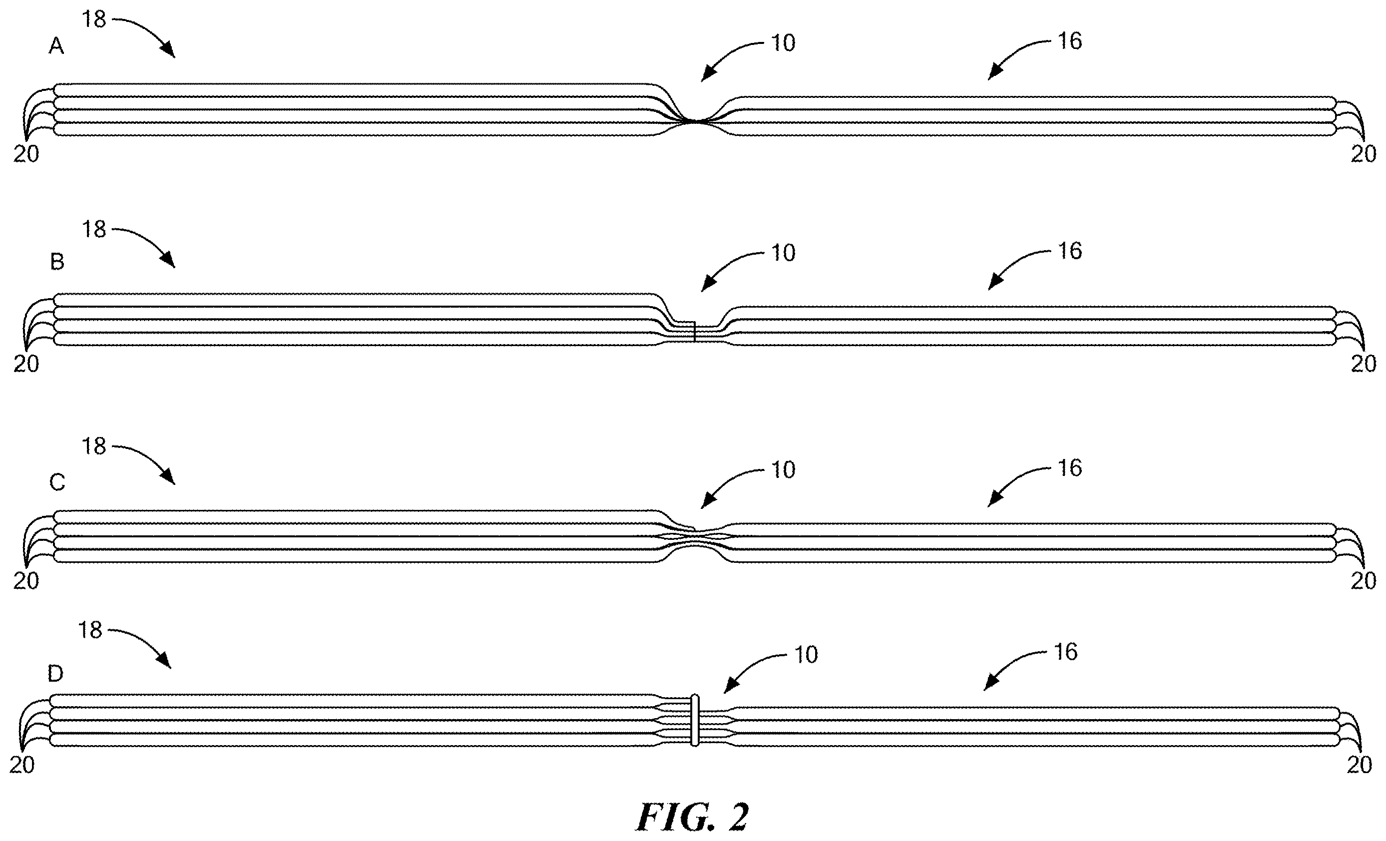 Patent US12611036 Figure 2 – Stackable lift for ischial tuberosity re-alignment of sacral/lumbar complex and method of use