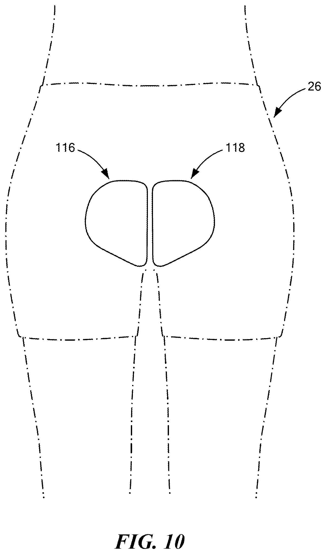 Patent US12611036 Figure 9 – Stackable lift for ischial tuberosity re-alignment of sacral/lumbar complex and method of use