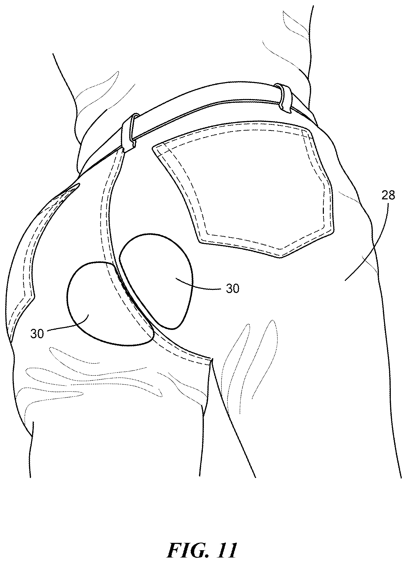 Patent US12611036 Figure 10 – Stackable lift for ischial tuberosity re-alignment of sacral/lumbar complex and method of use