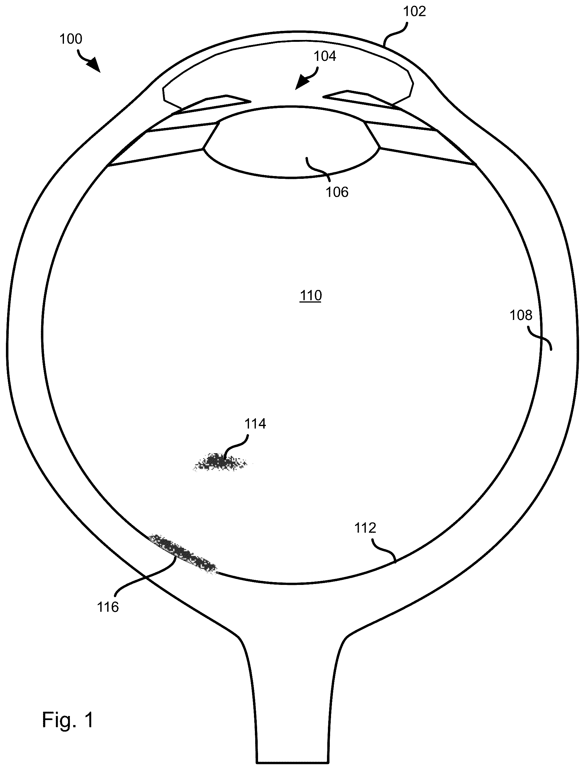 Patent US12611099 Figure 1 – Psychophysical evaluation of the effect of vitreous floaters