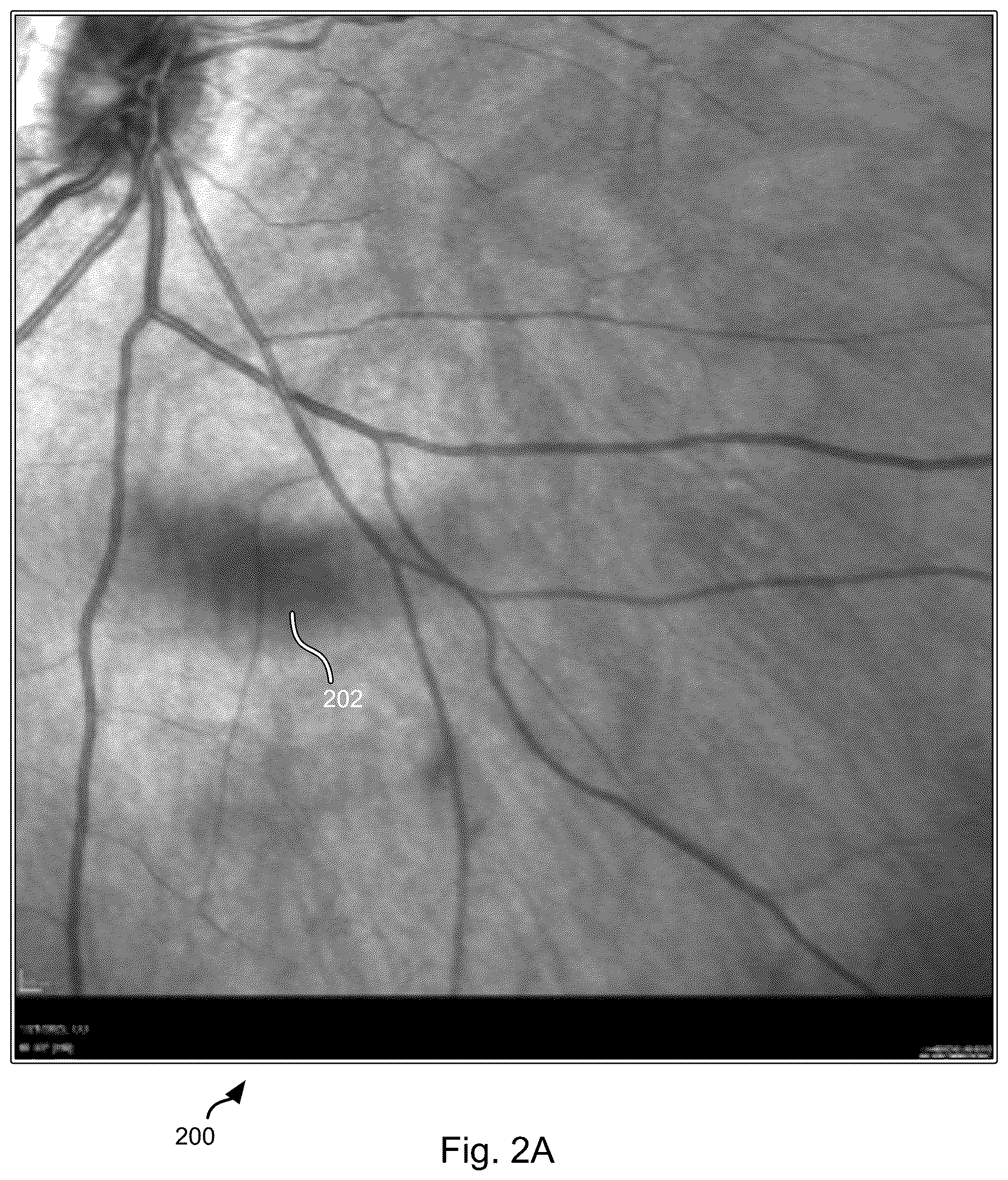 Patent US12611099 Figure 2 – Psychophysical evaluation of the effect of vitreous floaters