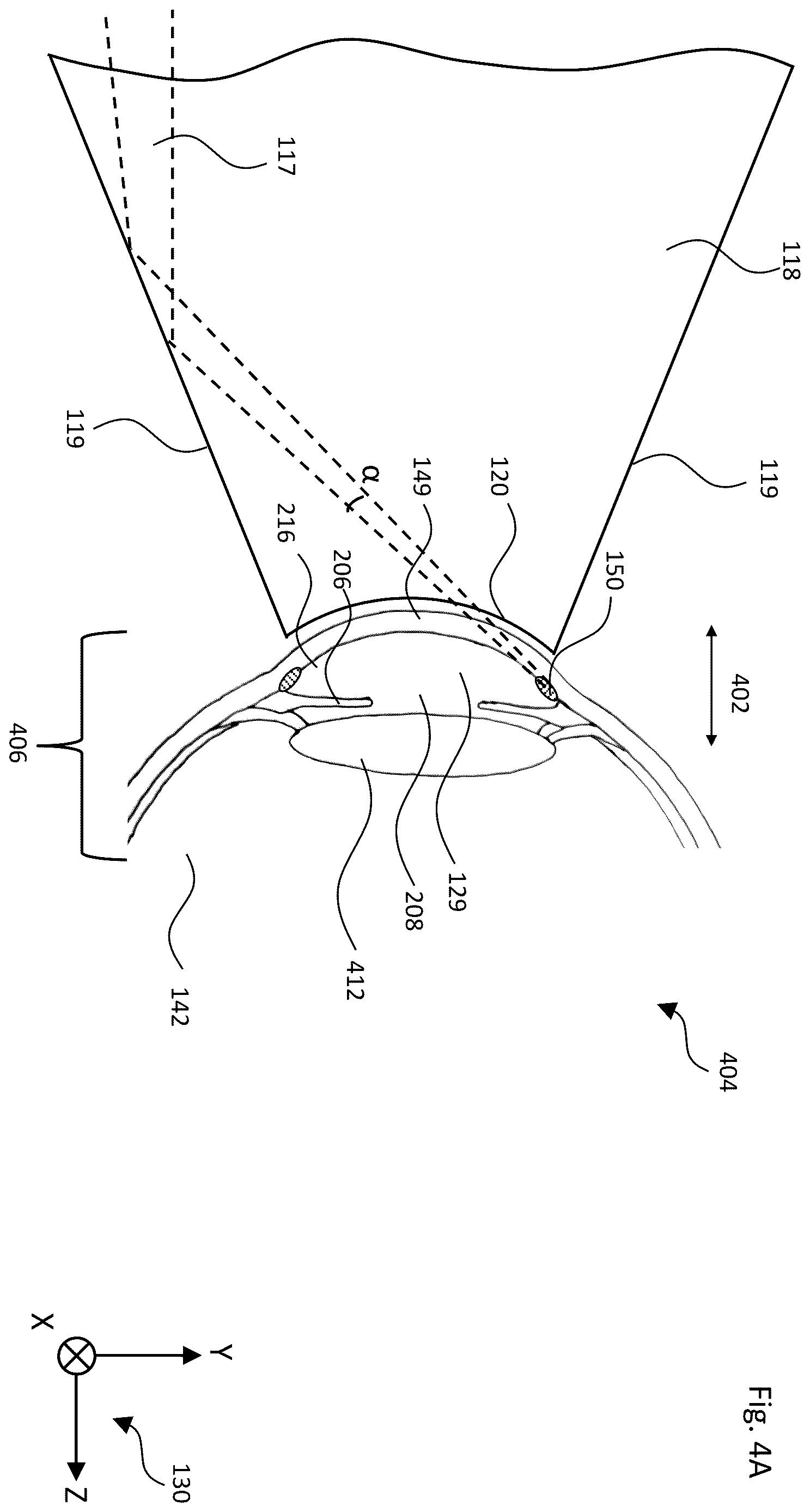 Patent US12611101 Figure 4 – Gonioscopic laser surgery