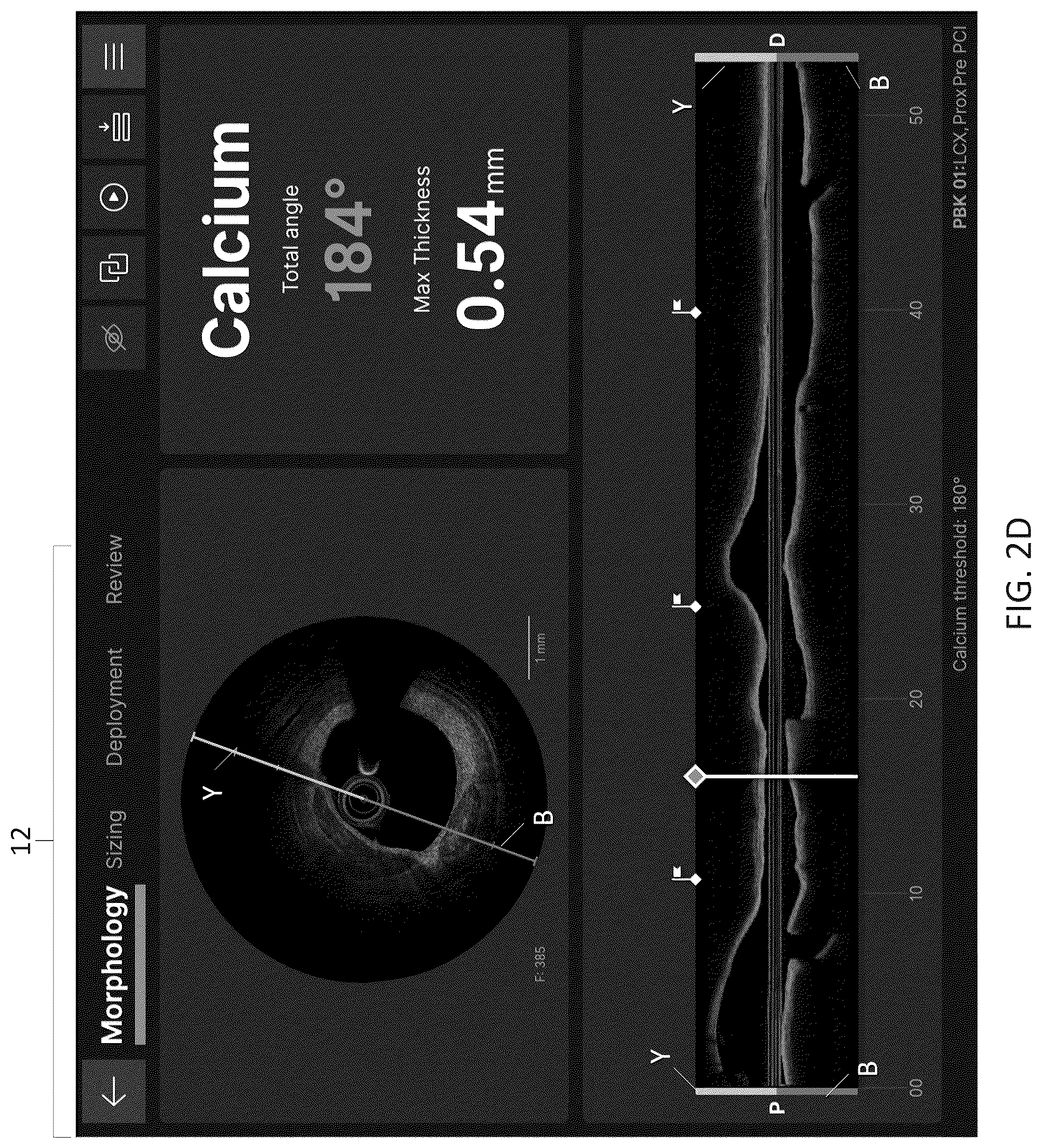 Patent US12611105 Figure 5 – Arterial imaging and assessment systems and methods and related user interface based-workflows