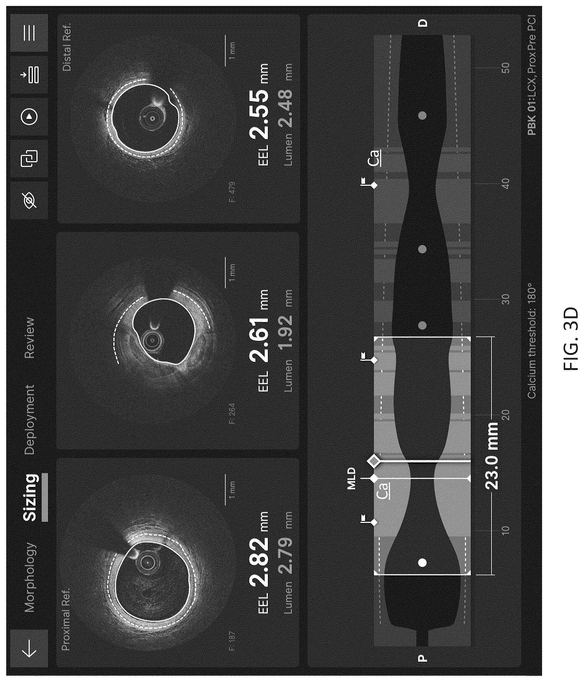 Patent US12611105 Figure 11 – Arterial imaging and assessment systems and methods and related user interface based-workflows