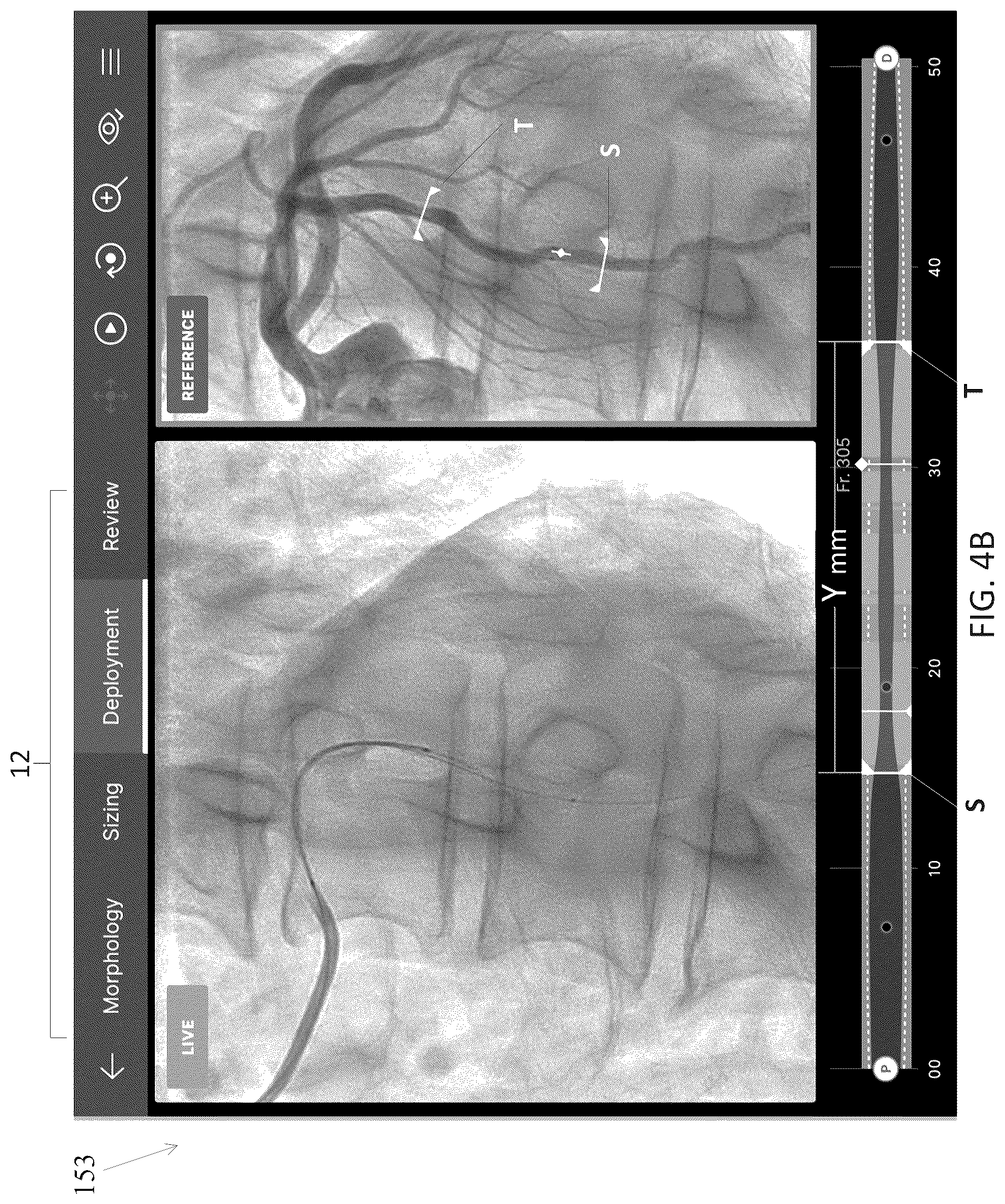 Patent US12611105 Figure 13 – Arterial imaging and assessment systems and methods and related user interface based-workflows