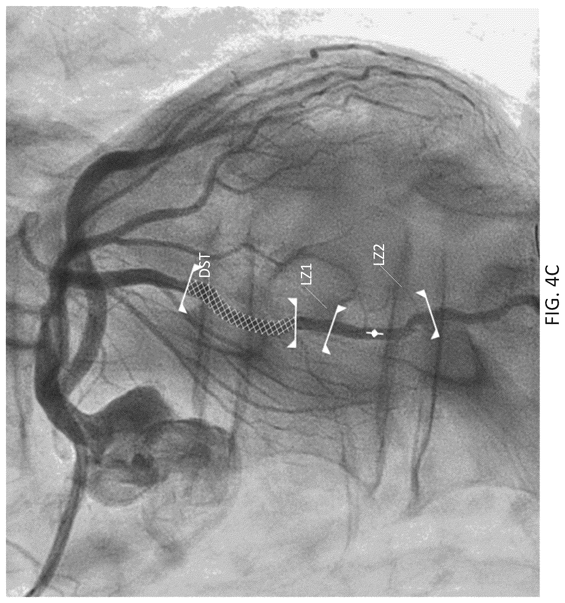 Patent US12611105 Figure 14 – Arterial imaging and assessment systems and methods and related user interface based-workflows