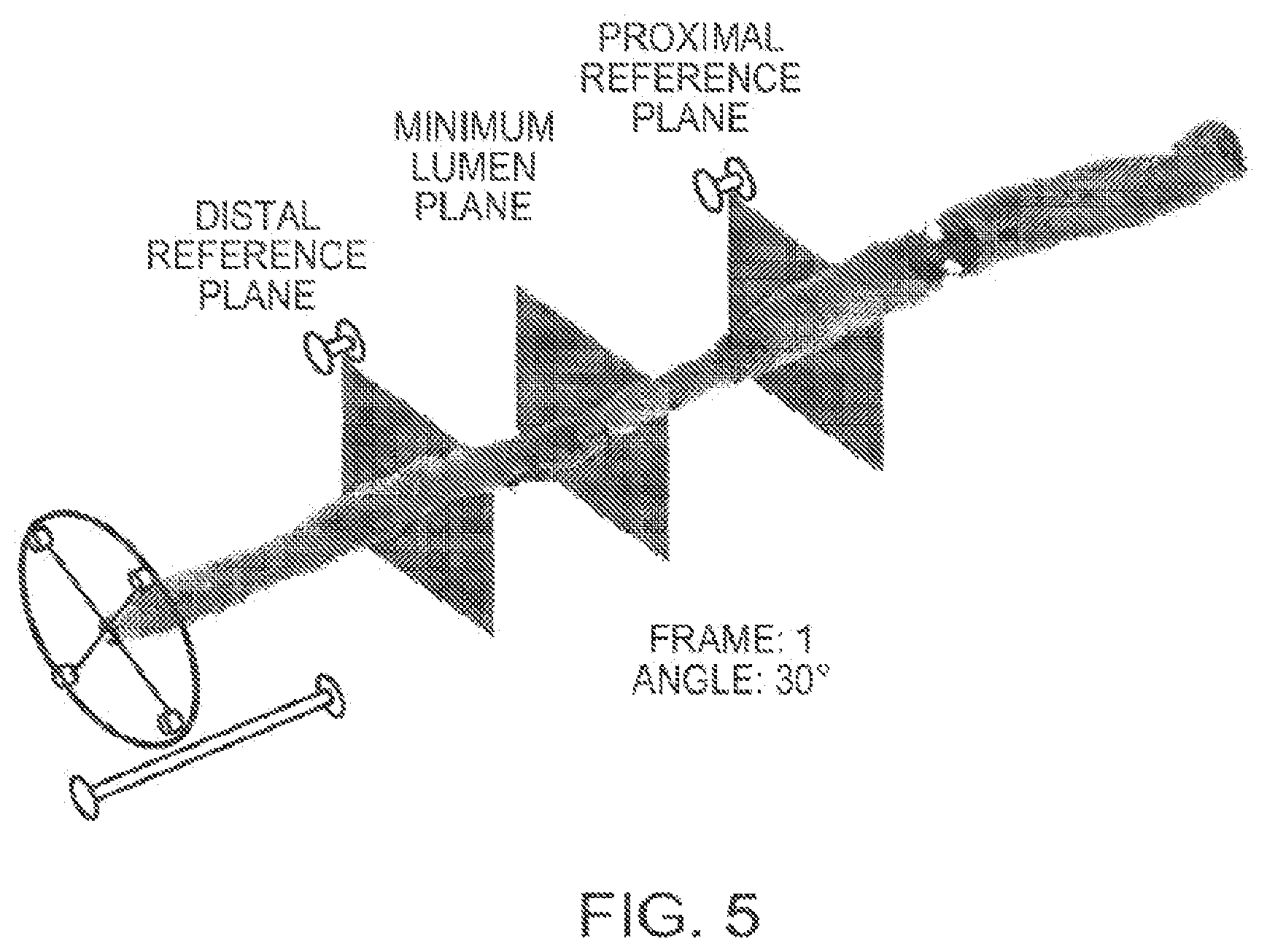 Patent US12611107 Figure 5 – Lumen morphology and vascular resistance measurements data collection systems, apparatus and methods