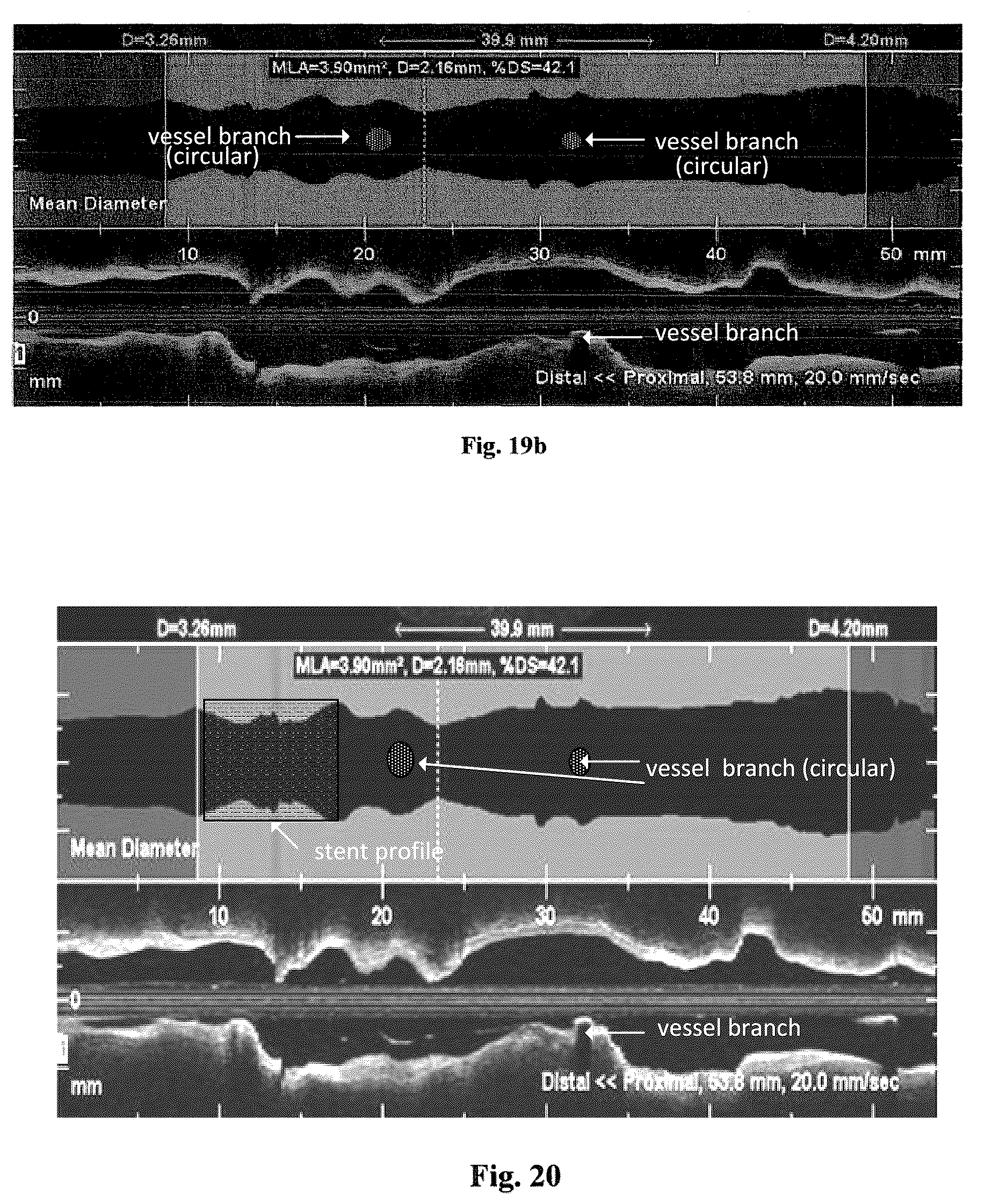 Patent US12611108 Figure 17 – Lumen morphology and vascular resistance measurements data collection systems apparatus and methods