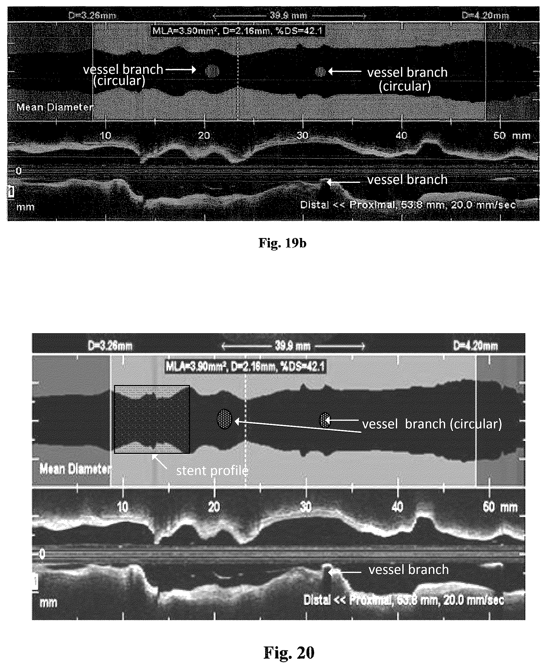 Patent US12611109 Figure 17 – Lumen morphology and vascular resistance measurements data collection systems apparatus and methods