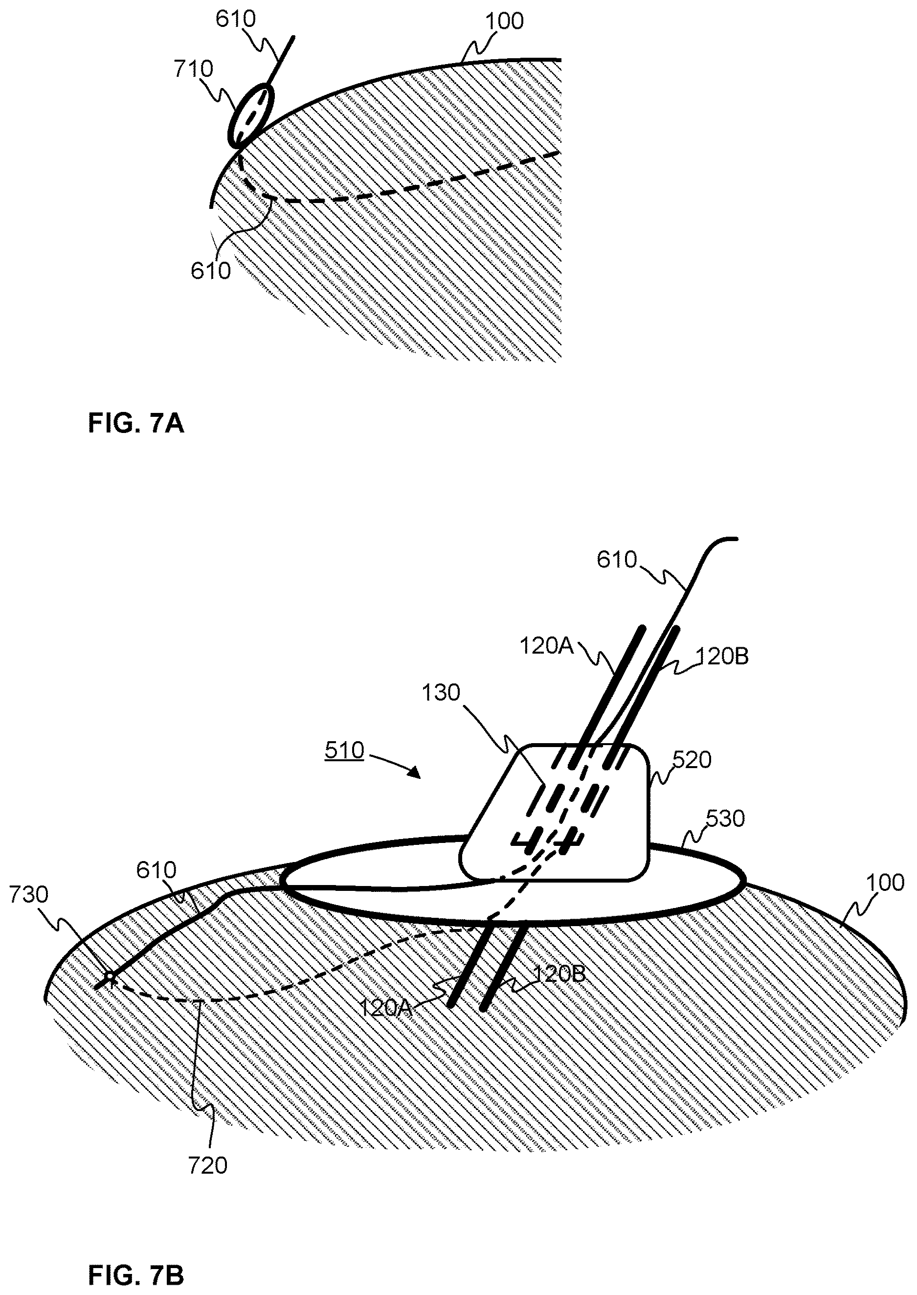 Patent US12611123 Figure 4 – Myocardial spectrometer probe and a method of monitoring the heart muscle