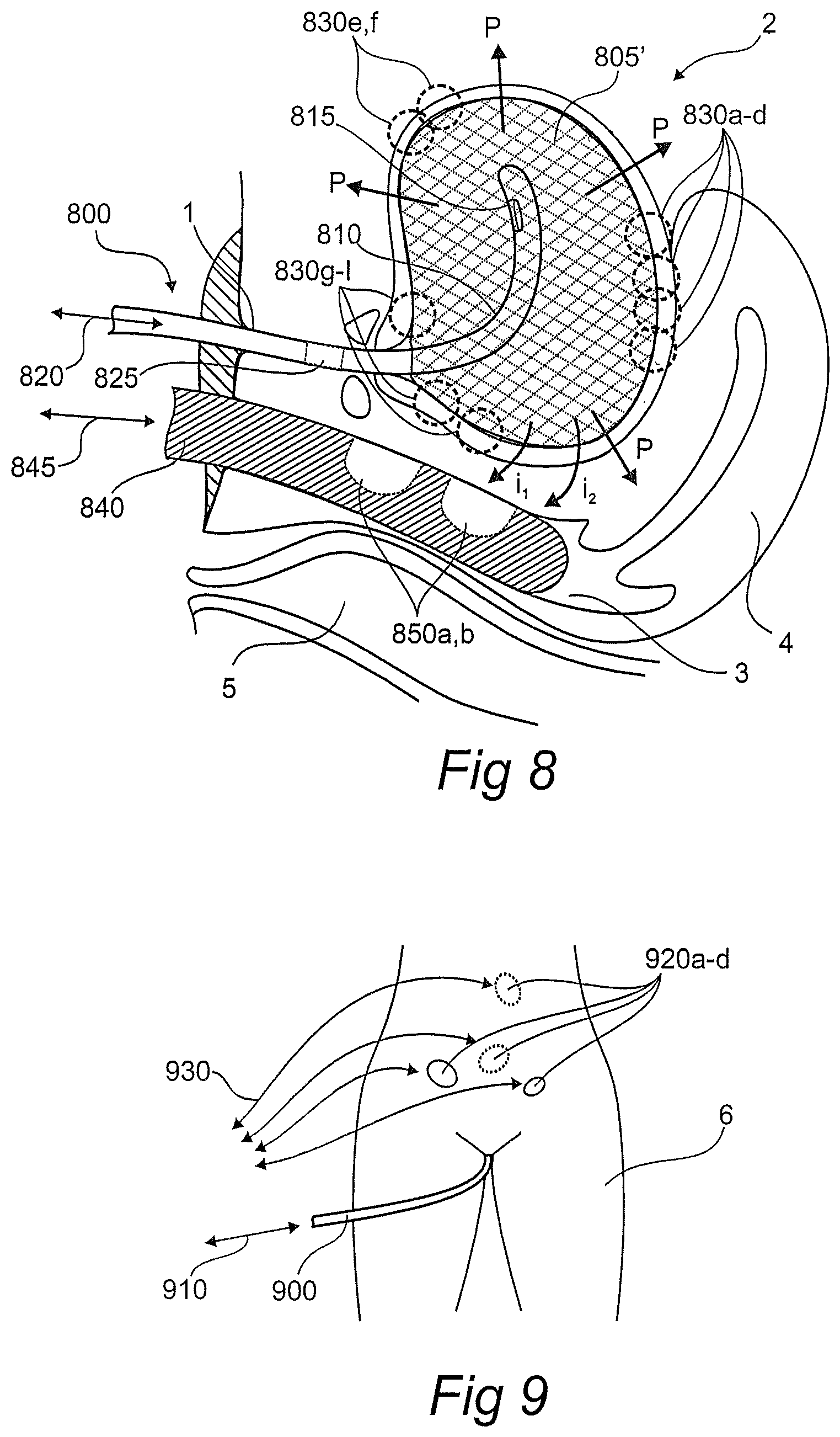Patent US12611134 Figure 5 – Devices, systems, and methods for diagnosis and treatment of overactive bladder