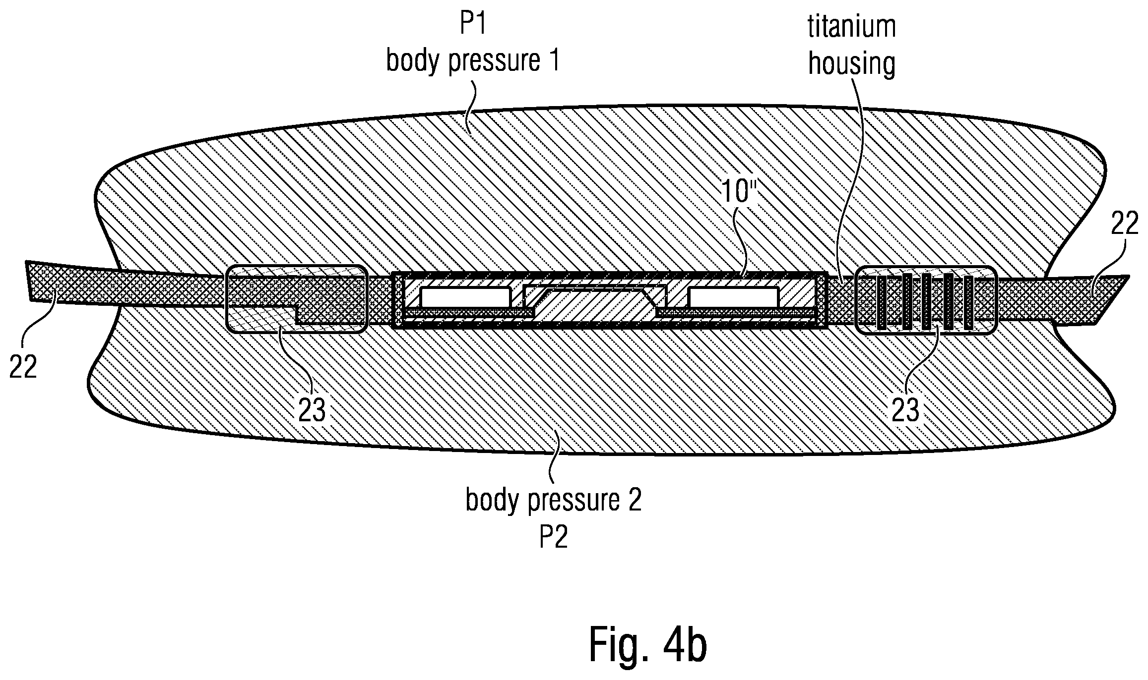 Patent US12611144 Figure 9 – Implant