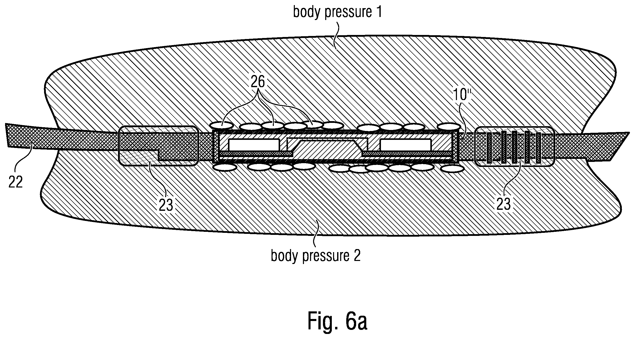 Patent US12611144 Figure 11 – Implant