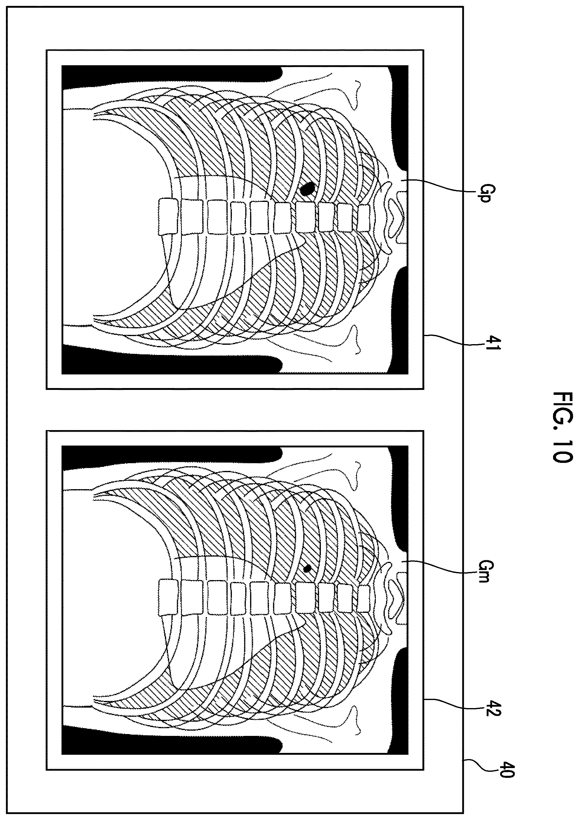 Patent US12611157 Figure 7 – Radiation image processing device, radiation image processing method, and radiation image processing program