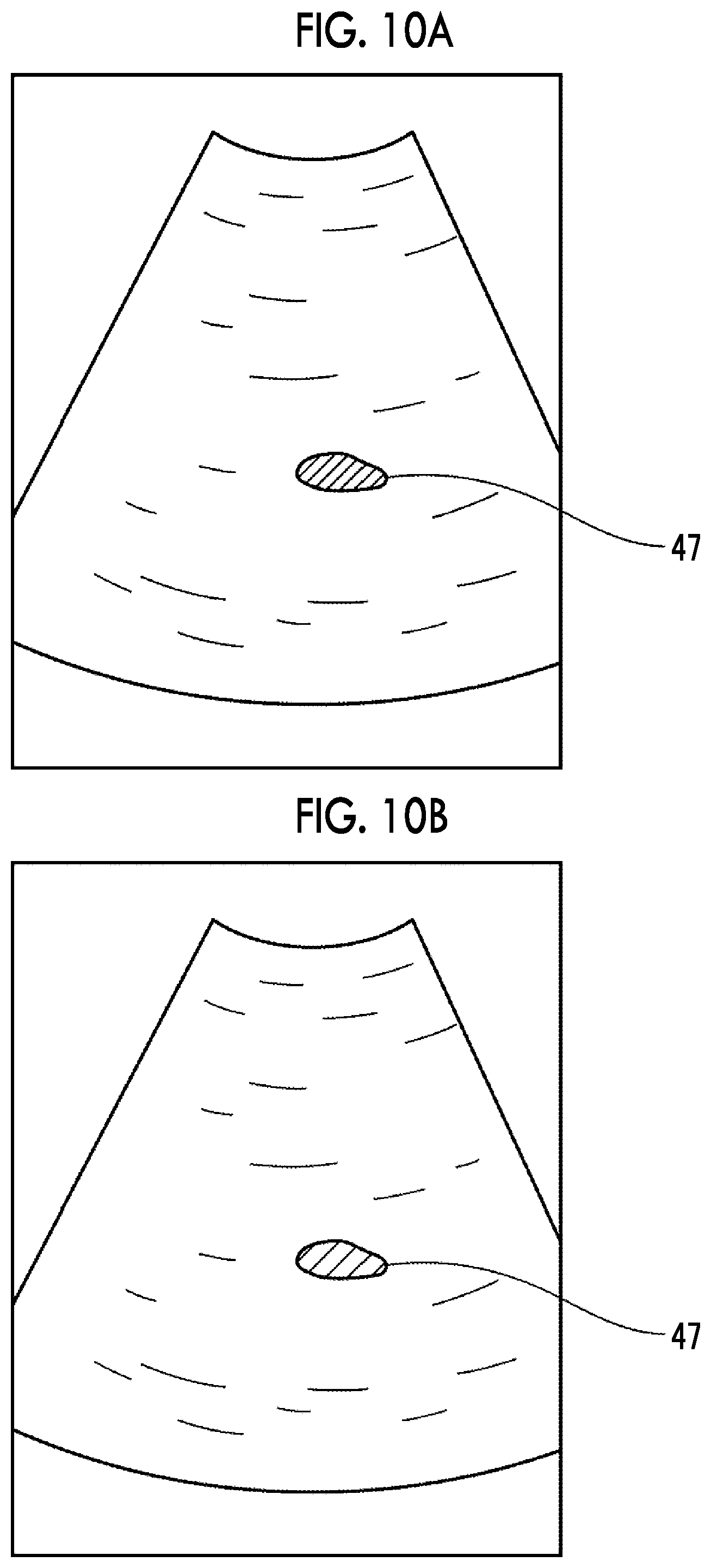 Patent US12611164 Figure 9 – Ultrasound diagnostic apparatus with function for highlight-displaying excrement region in ultrasound image and control method for ultrasound diagnostic apparatus