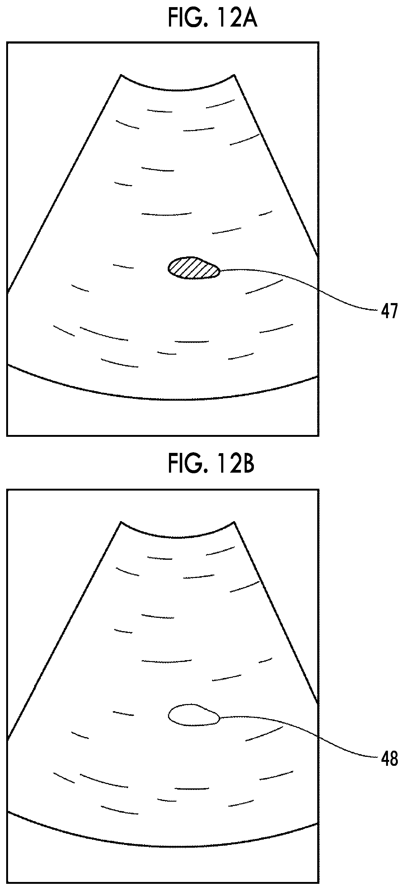 Patent US12611164 Figure 11 – Ultrasound diagnostic apparatus with function for highlight-displaying excrement region in ultrasound image and control method for ultrasound diagnostic apparatus