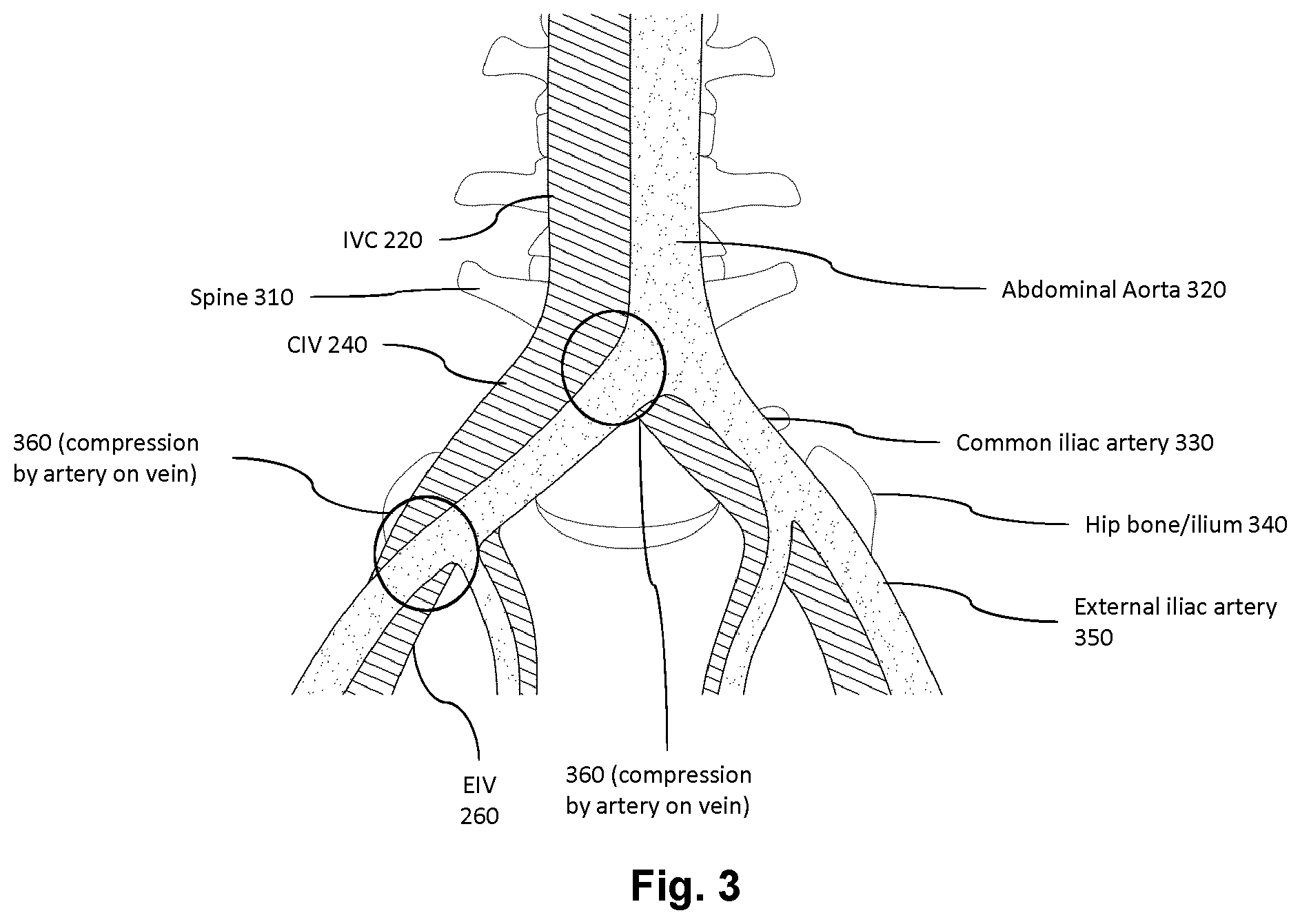 Patent US12611166 Figure 3 – Intraluminal ultrasound vessel segment identification and associated devices, systems, and methods