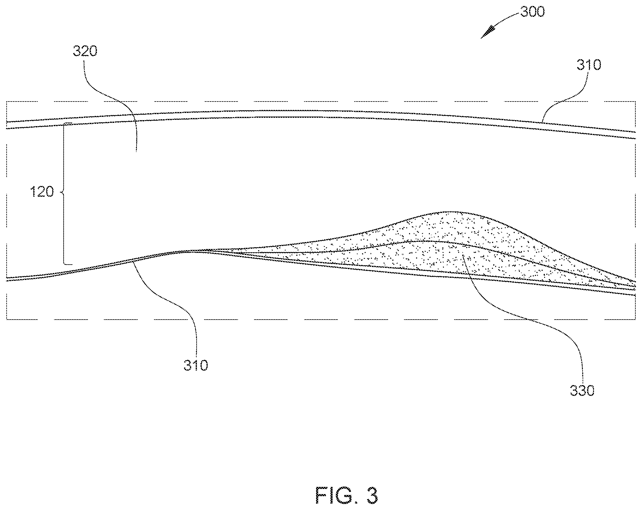 Patent US12611169 Figure 3 – Intraluminal ultrasound imaging with automatic and assisted labels and bookmarks