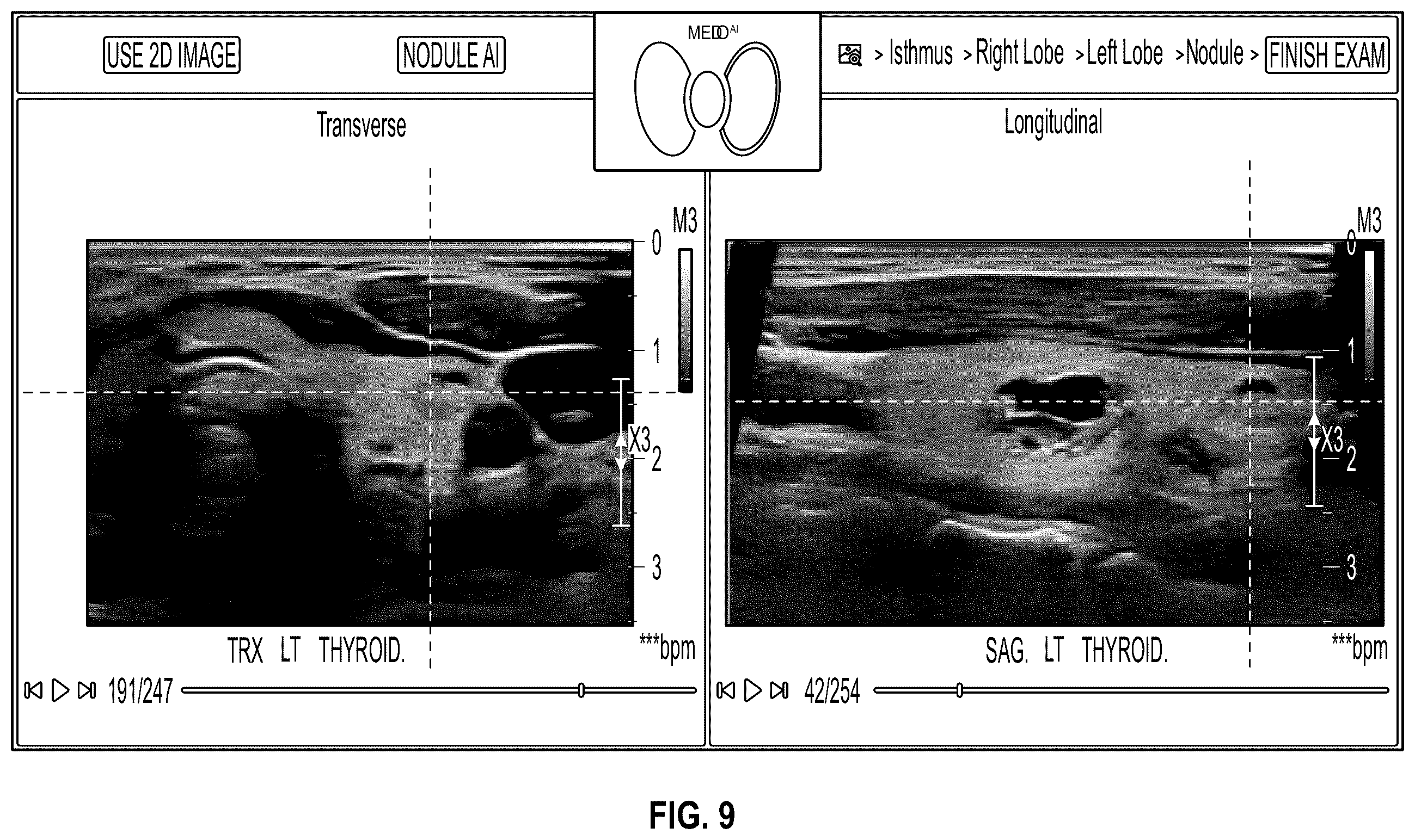 Patent US12611180 Figure 11 – Method and system for cross-referencing of two-dimensional (2D) ultrasound scans of a tissue volume
