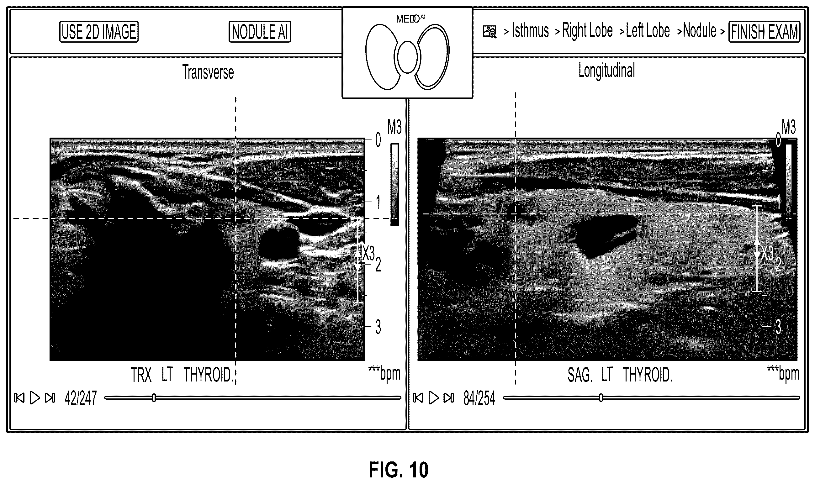Patent US12611180 Figure 12 – Method and system for cross-referencing of two-dimensional (2D) ultrasound scans of a tissue volume