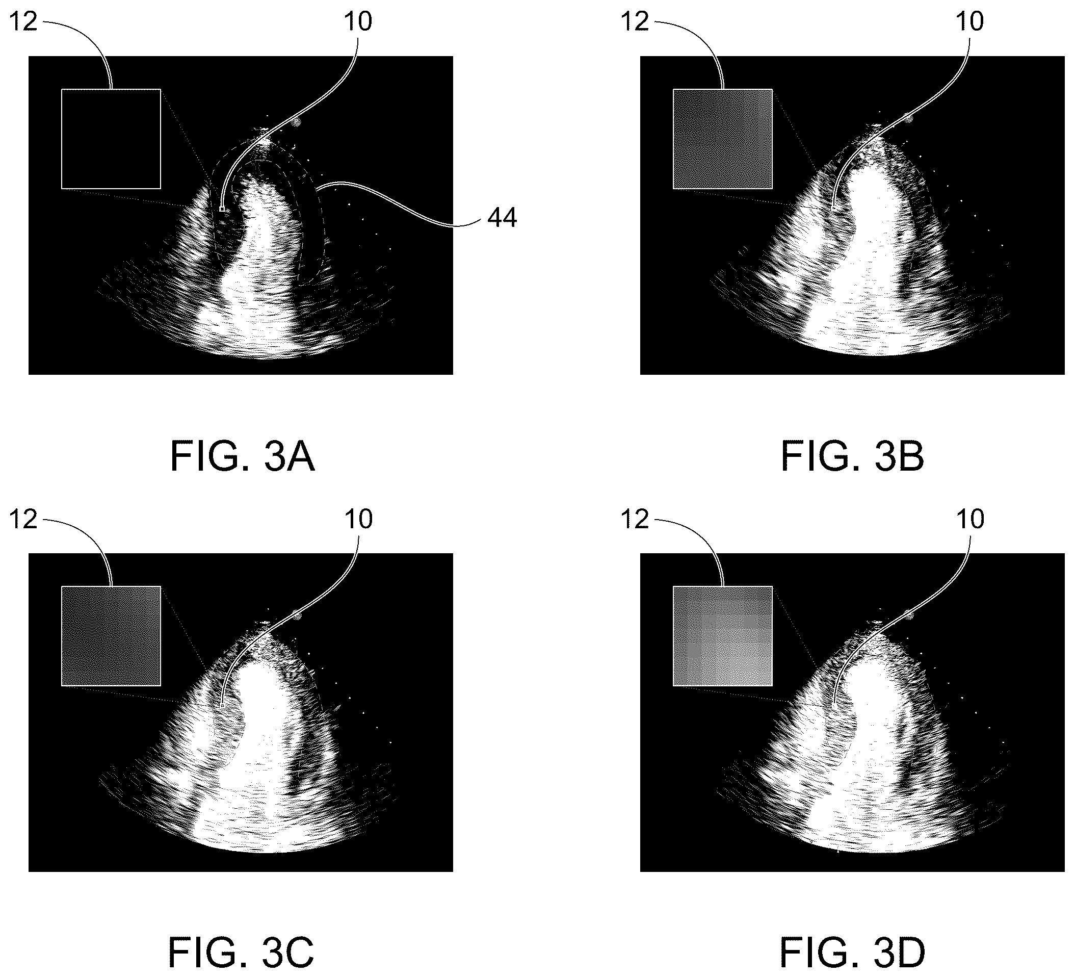 Patent US12611181 Figure 3 – Methods for displaying replenishment time data using myocardial contrast echocardiography and related systems