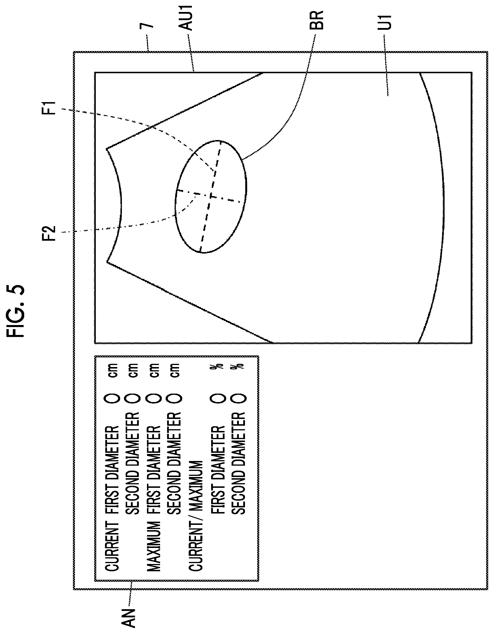Patent US12611190 Figure 4 – Ultrasound diagnostic apparatus and control method of ultrasound diagnostic apparatus for measuring a volume of a bladder of a subject