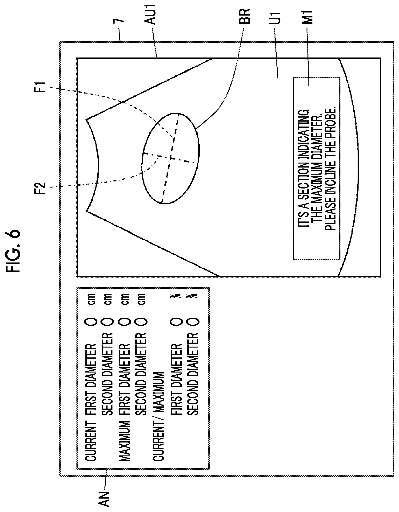 Patent US12611190 Figure 5 – Ultrasound diagnostic apparatus and control method of ultrasound diagnostic apparatus for measuring a volume of a bladder of a subject