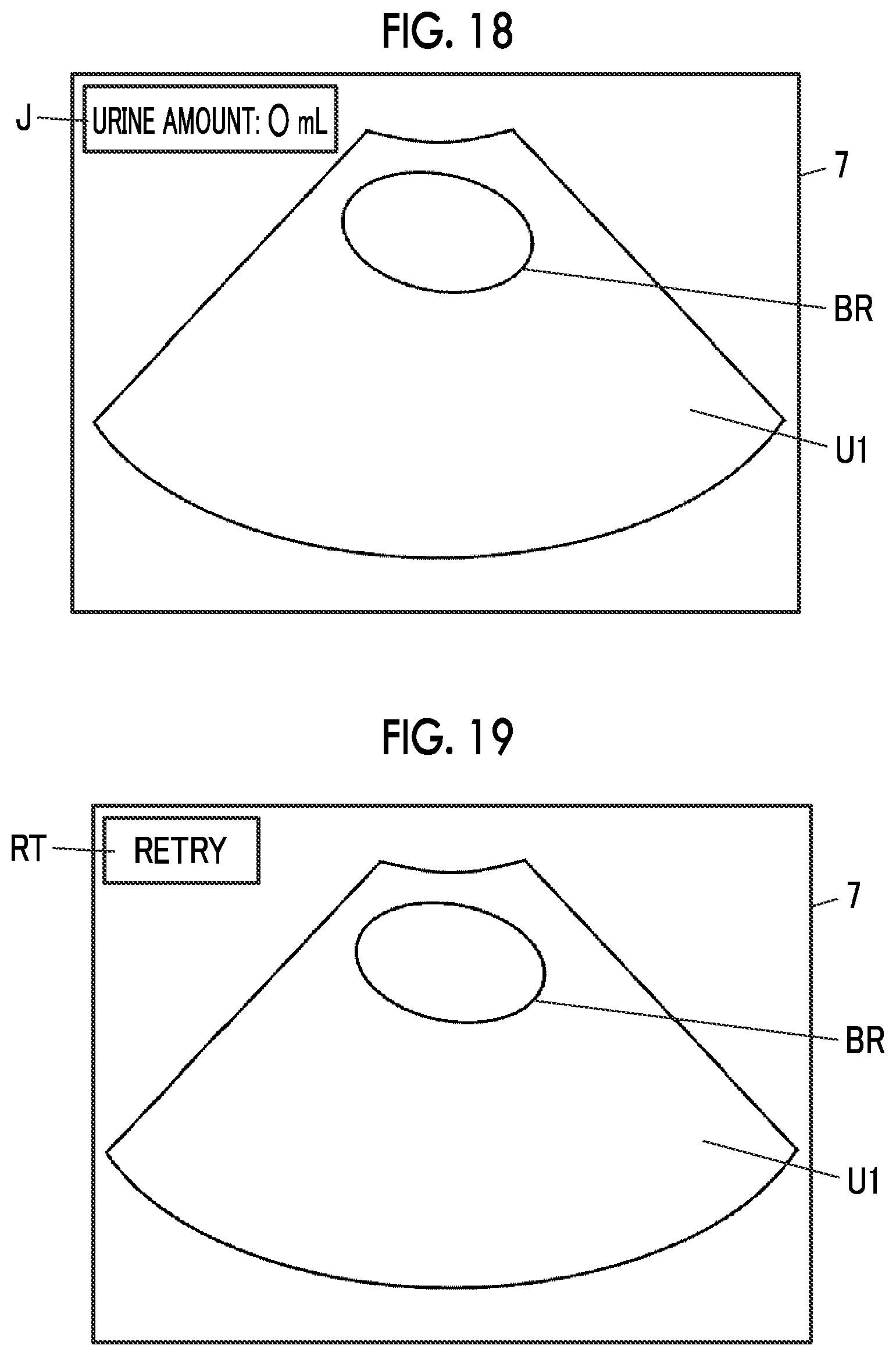Patent US12611190 Figure 15 – Ultrasound diagnostic apparatus and control method of ultrasound diagnostic apparatus for measuring a volume of a bladder of a subject